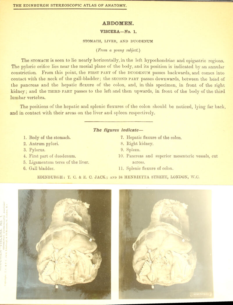 ABDOMEN. VISCERA—No. 1. STOMACH, LIVER, AND DUODENUM (From a young subject.) The stomach is seen to lie nearly horizontally, in the left hypochondriac and epigastric regions. The pyloric orifice lies near the mesial plane of the body, and its position is indicated by an annular constriction. From this point, the first part of the duodenum passes backwards, and comes into contact with the neck of the gall-bladder; the second part passes downwards, between the head of the pancreas and the hepatic Rexure of the colon, and, in this specimen, in front of the right kidney; and the third part passes to the left and then upwards, in front of the body of the third lumbar vertebra. The positions of the hepatic and splenic flexures of the colon should be noticed, lying far back, and in contact with their areas on the liver and spleen respectively. The figures indicate— 1. Body of the stomach. 2. Antrum pylori. 3. Pylorus. 4. First part of duodenum. 5. Ligamentum teres of the liver. 6. Gall bladder. 7. Hepatic flexure of the colon. 8. Right kidney. 9. Spleen. 10. Pancreas and superior mesenteric vessels, cut across. 11. Splenic flexure of colon.