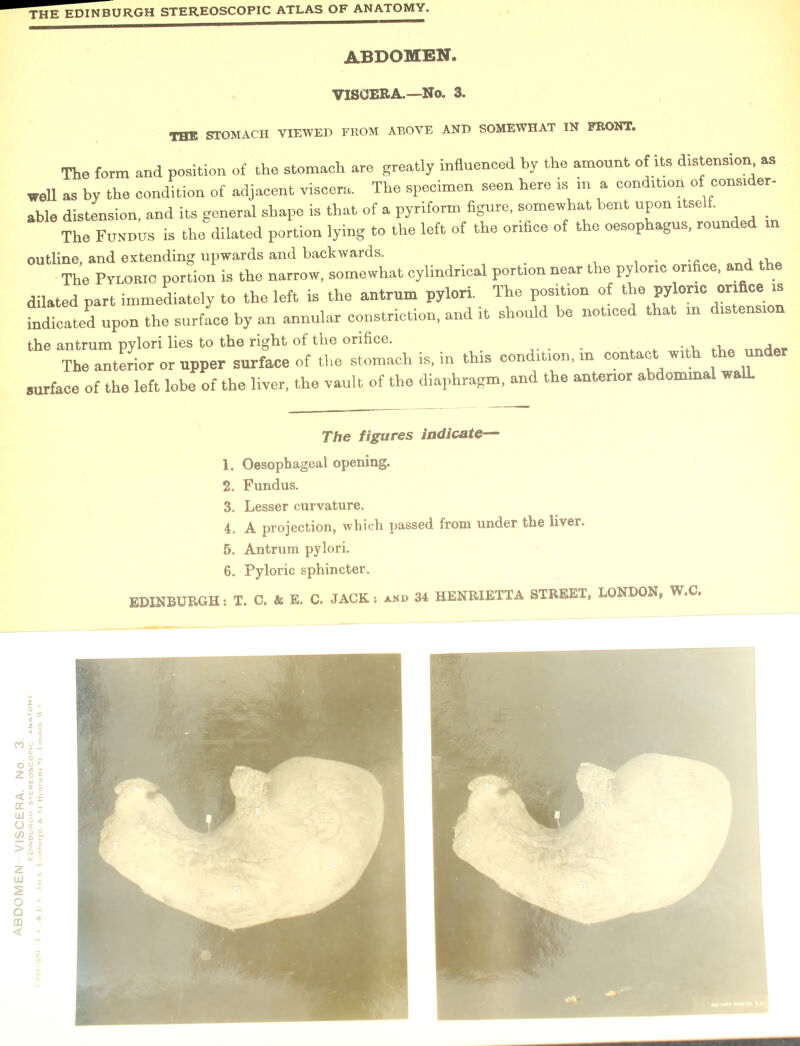 THE stomach viewed from above and somewhat in front. The form and position of the stomach are greatly influenced by the amount of its distension as well as by the condition of adjacent viscera. The specimen seen here is in a condition of consider- able distension, and its general shape is that of a pyriform figure, somewhat bent upon itself. The Fundus is the dilated portion lying to the left of the orifice of the oesophagus, rounded in outline, and extending upwards and backwards. fll_ The Pyloric portion is the narrow, somewhat cylindrical portion near the pyloric orifice, and the dilated part immediately to the left is the antrum pylori. The position of the pyloric orifice is indicated upon the surface by an annular constriction, and it should be noticed that in distension the antrum pylori lies to the right of the orifice. ... . , . . The anterior or upper surface of the stomach is, m this condition, in contact wi le un surface of the left lobe of the liver, the vault of the diaphragm, and the anterior abdominal walL 1. Oesophageal opening. 2. Fundus. 3. Lesser curvature. 4. A projection, which passed from under the liver. 5. Antrum pylori. 6. Pyloric sphincter.