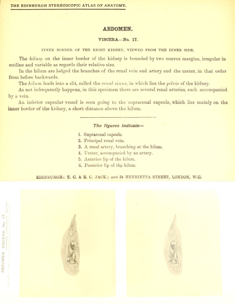 INNER BORDER OF THE RIGHT KIDNEY, VIEWED FROM THE INNER SIDE. outline and variable as regards their relative size. In the hilum are lodged the branches of the renal vein and artery and the ureter, in that order from before backwards. The hilum leads into a slit, called the renal sinus, in which lies the pelvis of the kidney. As not infrequently happens, in this specimen there are several renal arteries, each accompanied by a vein. An inferior capsular vessel is seen going to the suprarenal capsule, which lies mainly on the inner border of the kidney, a short distance above the hilum. 1. Suprarenal capsule. 2. Principal renal vein. 3. A renal artery, branching at the hilum. 4. Ureter, accompanied by an artery. 5. Anterior lip of the hilum. 6. Posterior lip of the hilum.