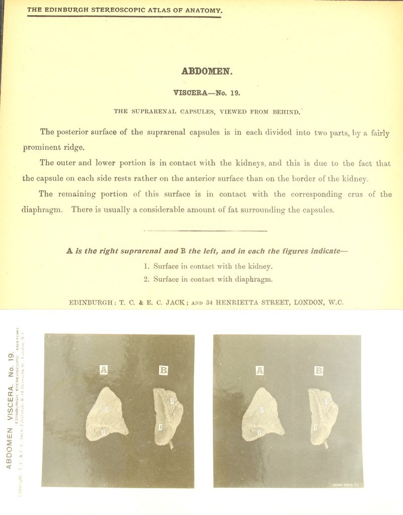 THE SUPRARENAL CAPSULES, VIEWED FROM BEHIND.' The posterior surface of the suprarenal capsules is in each divided into two parts, by a fairly prominent ridge. The outer and lower portion is in contact with the kidneys, and this is due to the fact that the capsule on each side rests rather on the anterior surface than on the border of the kidney. The remaining portion of this surface is in contact with the corresponding crus of the diaphragm. There is usually a considerable amount of fat surrounding the capsules. 2. Surface in contact with diaphragm.