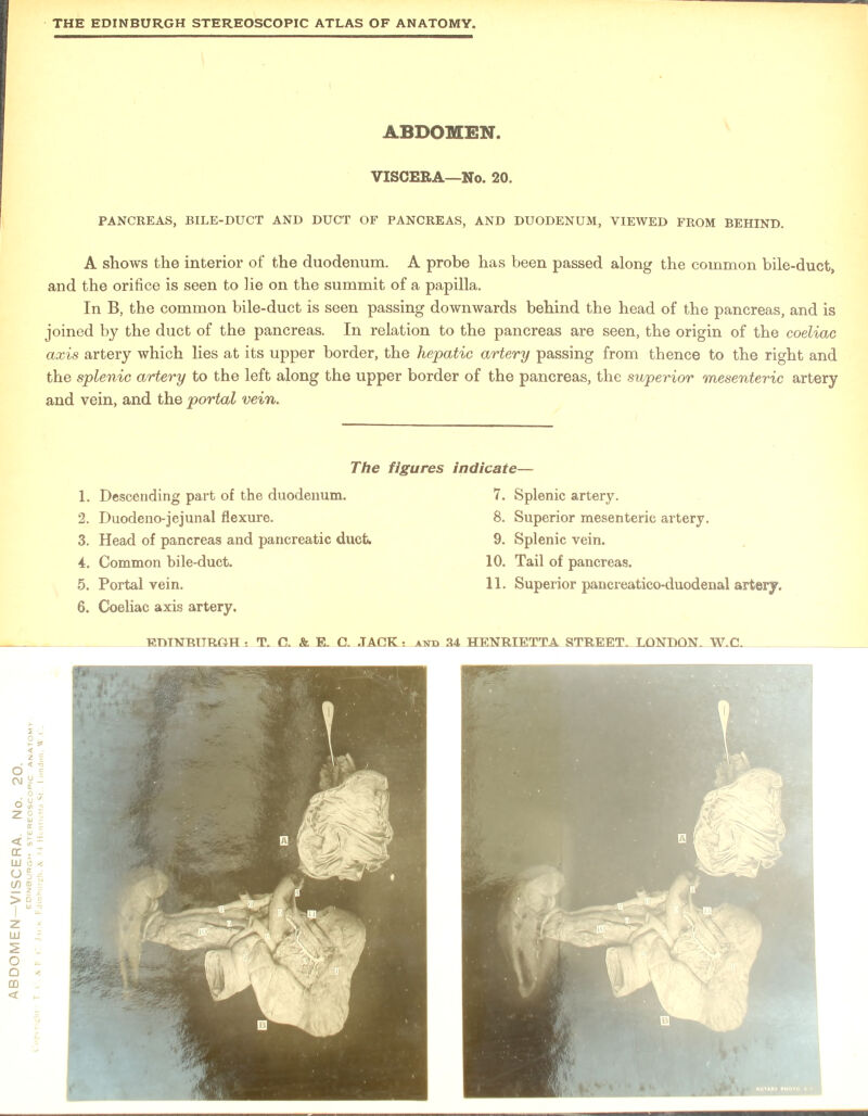 PANCREAS, BILE-DUCT AND DUCT OF PANCREAS, AND DUODENUM, VIEWED FROM BEHIND. A shows the interior of the duodenum. A probe has been passed along the common bile-duct, and the orifice is seen to lie on the summit of a papilla. In B, the common bile-duct is seen passing downwards behind the head of the pancreas, and is joined by the duct of the pancreas. In relation to the pancreas are seen, the origin of the coeliac axis artery which lies at its upper border, the hepatic artery passing from thence to the right and the splenic artery to the left along the upper border of the pancreas, the superior mesenteric artery and vein, and the portal vein. The figures 2. Duodeno-jejunal flexure. 3. Head of pancreas and pancreatic duct. 4. Common bile-duct. indicate— 8. Superior mesenteric artery. 9. Splenic vein. 10. Tail of pancreas.