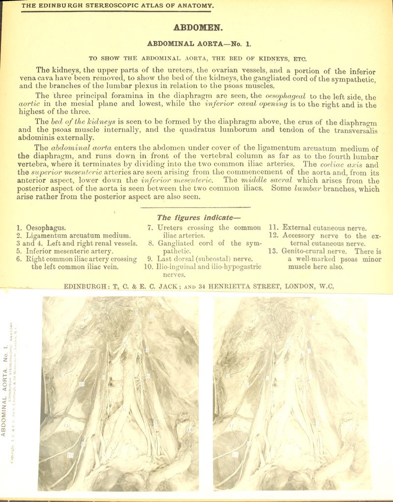 ABDOMINAL AORTA. TO SHOW THE ABDOMINAL AORTA, THE BED OF KIDNEYS, ETC. The kidneys, the upper parts of the ureters, the ovarian vessels, and a portion of the inferior vena cava have been removed, to show the bed of the kidneys, the gangliated cord of the sympathetic, and the branches of the lumbar plexus in relation to the psoas muscles. The three principal foramina in the diaphragm are seen, the oesophageal to the left side, the aortic in the mesial plane and lowest, while the inferior caval opening is to the right and is the highest of the three. The bed of the kidneys is seen to be formed by the diaphragm above, the crus of the diaphragm and the psoas muscle internally, and the quadratus lumborum and tendon of the transversalis The abdominal aorta enters the abdomen under cover of the ligamentum arcuatum medium of the diaphragm, and runs down in front of the vertebral column as far as to the fourth lumbar vertebra, where it terminates by dividing into the two common iliac arteries. The coeliac axis and the superior mesenteric arteries are seen arising from the commencement of the aorta and, from its anterior aspect, lower down the inferior mesenteric. The middle sacral which arises from the posterior aspect of the aorta is seen between the two common iliacs. Some lumbar branches, which arise rather from the posterior aspect are also seen. 2. Ligamentum arcuatum medium. 5. Inferior mesenteric artery. 6. Right common iliac artery crossing the left common iliac vein. iliac arteries. pathetic. 9. Last dorsal (subcostal) nerve. 10. Uio-inguinal and ilio-hypogastric nerves. 12. Accessory nerve to the ex- 13. Genito-crural nerve. There is a well-marked psoas minor muscle here also.