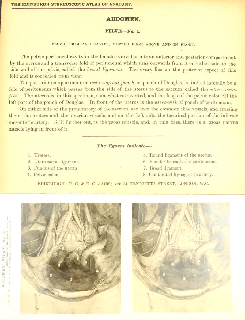 PELVIC BRIM AND CAVITY, VIEWED FROM ABOVE AND IN FRONT. The pelvic peritoneal cavity in the female is divided into an anterior and posterior compartment by the uterus and a transverse fold of peritoneum which runs outwards from it on either side to the side wall of the pelvis, called the broad ligament. The ovary lies on the posterior aspect of this fold and is concealed from view. The posterior compartment or recto-vaginal pouch, or pouch of Douglas, is limited laterally by a fold of peritoneum which passes from the side of the uterus to the sacrum, called the utero-sacral fold. The uterus is, in this specimen, somewhat retroverted, and the loops of the pelvic colon fill the left part of the pouch of Douglas. In front of the uterus is the utero-vesical pouch of peritoneum. On either side of the promontory of the sacrum are seen the common iliac vessels, and crossing them, the ureters and the ovarian vessels, and on the left side, the terminal portion of the inferior mesenteric artery. Still further out, is the psoas muscle, and, in this case, there is a psoas parvus muscle lying in front of it. 2. Utero-sacral ligament. 6. Bladder beneath the peritoneum. 3. Fundus of the uterus. 1 7. Broad ligament. 4. Pelvic colon. 8. Obliterated hypogastric artery. 7