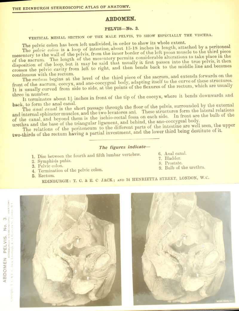 VERTICAL MESIAL SECTION OF THE MALE PELVIS, TO SHOW ESPECIALLY THE VISCERA. The nelvic colon has been left undivided, in order to show its whole extent. The \elvic colon is a loop of intestine, about 15-18 inches in length, attached by a peritoneal , tLp will of the nelvis from the inner border of the left psoas muscle to the third piece Scru,n The length P0f the mSentery permits considerable‘alterations to take place in the ot the sacrum, rne ie j r „ it flrst passes into the true pelvis it then c^s the pelvic cavity from 1X to right, and then Lids back to the middle line and becomes continuous with the rectum sacrum, and extends forwards on the thre irteZtoSes about 1J inches in front of the tip of the coccyx, where it bends downwards and Disc between the fourth and fifth lumbar vertebrae. 3. Pelvic colon. 4. Termination of the pelvic colon. 5. Rectum. EDINBURGH: T. C. & E. C 6. Anal canal. 8. Prostate. 9. Bulb of the urethra. JACK; and 34 HENRIETTA STREET, LONDON, W.C.