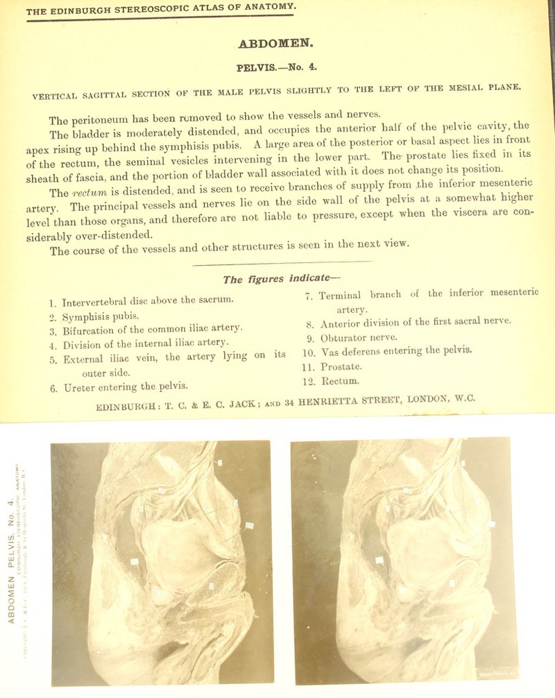VERTICAL SAGITTAL SECTION OF THE MALE PELVIS SLIGHTLY TO THE LEFT OF THE MESIAL PLANE. The peritoneum has been removed to show the vessels and nerves. The bladder is moderately distended, and occupies the anterior halt of the pelvic cavity the apex rising up behind the symphisis pubis. A large area of the posterior or basal aspect lies m front of the rectui, the seminal vesicles intervening in the lower part. The-prostate lies fixed in i s sheath of fascia, and the portion of bladder wall associated with it does not change its position. The rectum is distended, and is seen to receive branches of supply from .the inferior mesenteric artery The principal vessels and nerves lie on the side wall of the pelvis at a somewhat higher level than those organs, and therefore are not liable to pressure, except when the viscera are con- siderably over-distended. The course of the vessels and other structures is seen m the next view. 1. Intervertebral disc above the sacrum. 3. Bifurcation of the common iliac artery. 5. External iliac vein, the artery lying on its outer side. 6. Ureter entering the pelvis. EDINBURGH; T. C. & E. C. JACK; and 34 7. Terminal branch of the inferior mesenteric artery. 8. Anterior division of the first sacral nerve. 10. Vas deferens entering the pelvis. HENRIETTA STREET, LONDON, W.C.