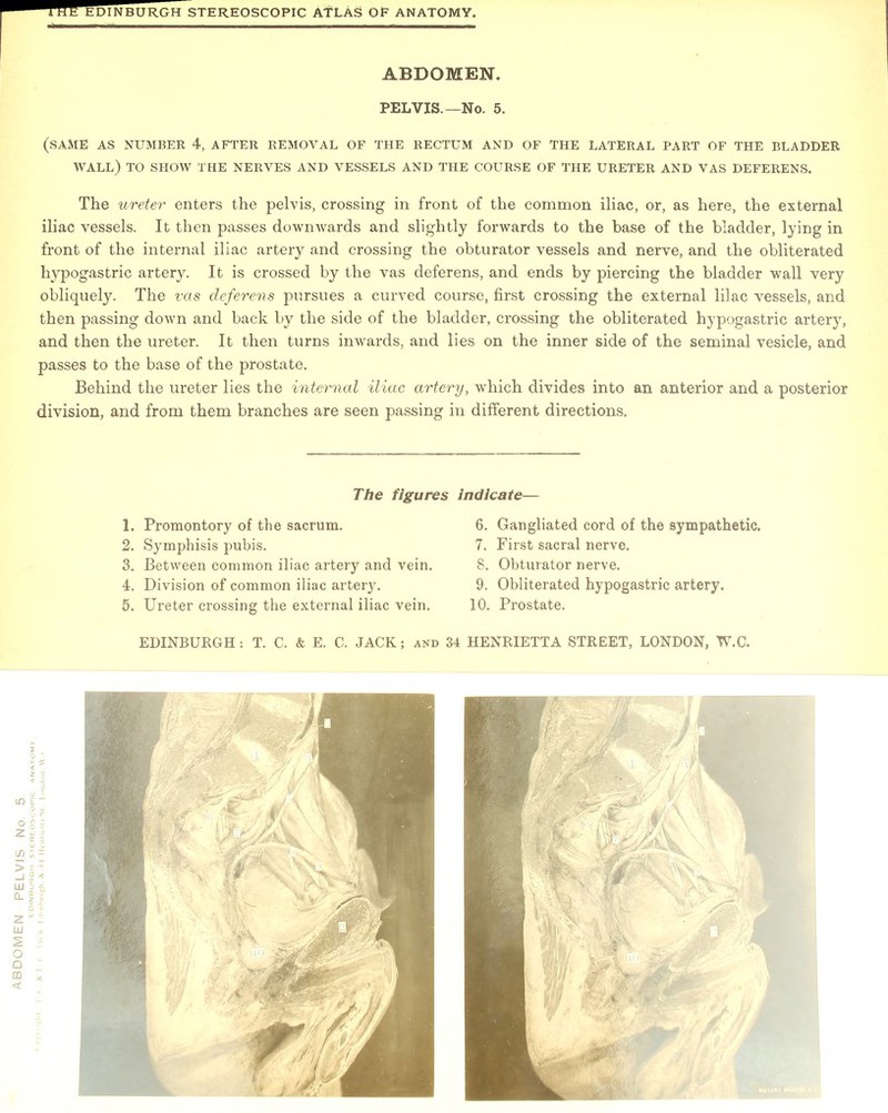 (SAME AS NUMBER 4, AFTER REMOVAL OF THE RECTUM AND OF THE LATERAL PART OF THE BLADDER WALL) TO SHOW THE NERVES AND VESSELS AND THE COURSE OF THE URETER AND VAS DEFERENS. The ureter enters the pelvis, crossing in front of the common iliac, or, as here, the external iliac vessels. It then passes dowmvards and slightly forwards to the base of the bladder, lying in front of the internal iliac artery and crossing the obturator vessels and nerve, and the obliterated hypogastric artery. It is crossed by the vas deferens, and ends by piercing the bladder wall very obliquely. The vas deferens pursues a curved course, first crossing the external lilac vessels, and then passing down and back by the side of the bladder, crossing the obliterated hypogastric artery, and then the ureter. It then turns inwards, and lies on the inner side of the seminal vesicle, and passes to the base of the prostate. Behind the ureter lies the internal iliac artery, which divides into an anterior and a posterior division, and from them branches are seen passing in different directions. 4. Division of common iliac artery. 5. Ureter crossing the external iliac vein. 9. Obliterated hypogastric artery. 10. Prostate.