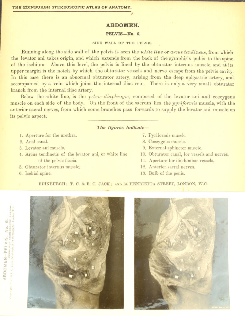 f Running along the side wall of the pelvis is seen the white line or arcus tendineus, from which the levator ani takes origin, and which extends from the back of the symphisis pubis to the spine of the ischium. Above this level, the pelvis is lined by the obturator internus muscle, and at its upper margin is the notch by which the obturator vessels and nerve escape from the pelvic cavity. In this case there is an abnormal obturator artery, arising from the deep epigastric artery, and accompanied by a vein which joins the internal iliac vein. There is only a very small obturator branch from the internal iliac artery. Below the white line, is the pelvic diaphragm, composed of the levator ani and coccygeus muscle on each side of the body. On the front of the sacrum lies the pyriformis muscle, with the anterior sacral nerves, from which some branches pass forwards to supply the levator ani muscle on its pelvic aspect. 1. Aperture for the urethra. 7. Pyriformis muscle. 2. Anal canal. 8. Coccygeus muscle. 3. Levator ani muscle. 9. External sphincter muscle. 4. Arcus tendineus of the levator ani, or white line 10. Obturator canal, for vessels and nerves. 5. Obturator internus muscle. 12. Anterior sacral nerves. 6. Ischial spine. 13. Bulb of the penis. <d o z y 9 U o = X ^ 0 45