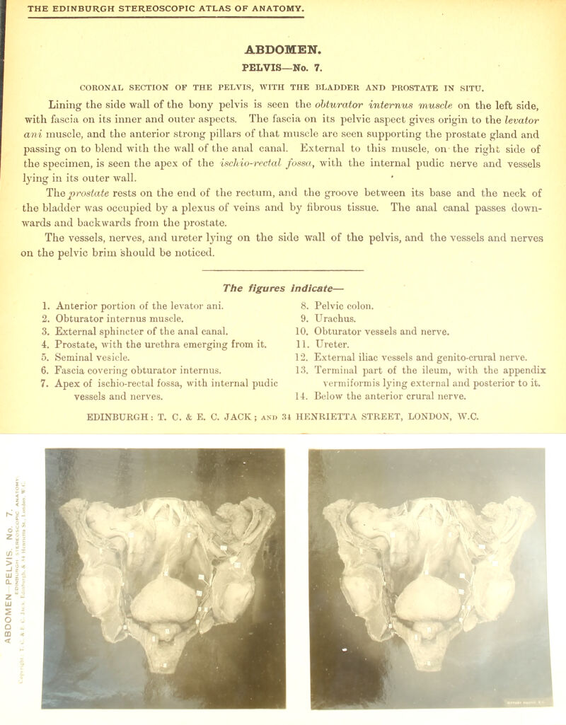 CORONAL SECTION OF THE PELVIS, WITH THE BLADDER AND PROSTATE IN SITU. Lining the side wall of the bony pelvis is seen the obturator internus muscle on the left side, with fascia on its inner and outer aspects. The fascia on its pelvic aspect gives origin to the levator ani muscle, and the anterior strong pillars of that muscle are seen supporting the prostate gland and passing on to blend with the wall of the anal canal. External to this muscle, on-the right side of the specimen, is seen the apex of the ischio-rectal fossa, with the internal pudic nerve and vessels lying in its outer wall. The prostate rests on the end of the rectum, and the groove between its base and the neck of the bladder was occupied by a plexus of veins and by fibrous tissue. The anal canal passes down- wards and backwards from the prostate. The vessels, nerves, and ureter lying on the side wall of the pelvis, and the vessels and nerves on the pelvic brim should be noticed. The figures 2. Obturator internus muscle. 6. Fascia covering obturator internus. 7. Apex of ischio-rectal fossa, with internal pudic vessels and nerves. indicate— 9. Urachus. 13. Terminal part of the ileum, with the appendix vermiform is lying external and posterior to it. 14. Below the anterior crural nerve.