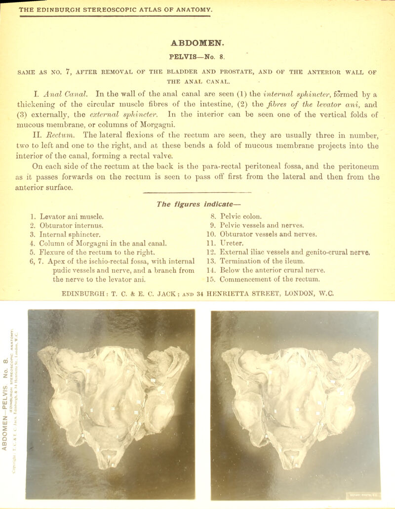 SAME AS NO. 7, AFTER REMOVAL OF THE BLADDER AND PROSTATE, AND OF THE ANTERIOR WALL OF I. Anal Canal. In the wall of the anal canal are seen (1) the internal sphincter, formed by a thickening of the circular muscle fibres of the intestine, (2) the fibres of the levator ani, and (3) externally, the external sphincter. In the interior can be seen one of the vertical folds of mucous membrane, or columns of Morgagni. two to left and one to the right, and at these bends a fold of mucous membrane projects into the interior of the canal, forming a rectal valve. On each side of the rectum at the back is the para-rectal peritoneal fossa, and the peritoneum as it passes forwards on the rectum is seen to pass off first from the lateral and then from the anterior surface. 6. 7. Apex of the ischio-rectal fossa, with internal the nerve to the levator ani. 13. Termination of the ileum. 15. Commencement of the rectum.