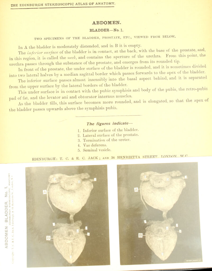 TWO SPECIMENS OF THE BLADDER, PROSTATE, ETC., VIEWED FROM BELOW. In A the bladder is moderately distended, and in B it is empty. The inferior surface of the bladder is in contact, at the back, with the base of the prostate, and, in this region, it is called the neck, and contains the aperture of the urethra. From this point, the urethra passes through the substance of the prostate, and emerges from its rounded tip. In front of the prostate, the under surface of the bladder is rounded, and it is sometimes divided into two lateral halves by a median sagittal border which passes forwards to the apex of the bladder The inferior surface passes almost insensibly into the basal aspect behind, an it is separatee from the upper surface by the lateral borders of the bladder. This under surface is in contact with the pubic symphisis and body of the pubis, the retro-pubic pad of fat, and the levator ani and obturator internus muscles. As the bladder fills, this surface becomes more rounded, and is elongated, so that the apex o the bladder passes upwards above the symphisis pubis. 1. Inferior surface of the bladder. 4. Vas deferens.