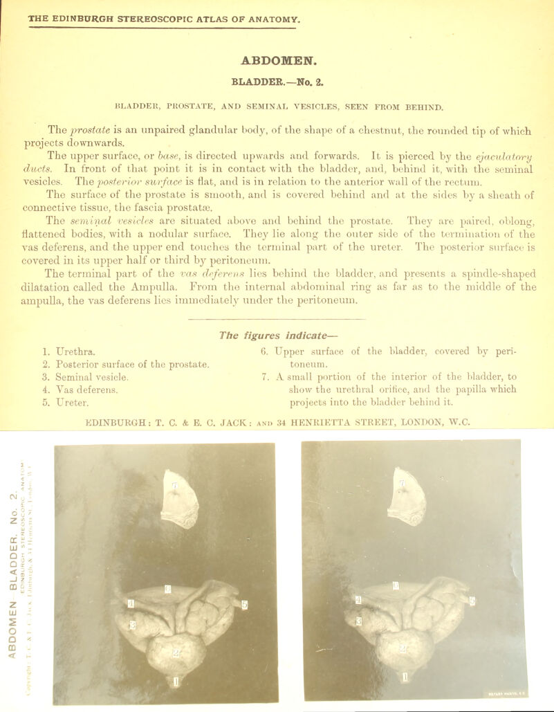 BLADDER, PROSTATE, AND SEMINAL VESICLES, SEEN FROM BEHIND. The prostate is an impaired glandular body, of the shape of a chestnut, the rounded tip of which projects downwards. The upper surface, or base, is directed upwards and forwards. It is pierced by the ejaculatory ducts. In front of that point it is in contact with the bladder, and, behind it, with the seminal vesicles. The posterior surface is flat, and is in relation to the anterior wall of the rectum. The surface of the prostate is smooth, and is covered behind and at the sides by a sheath of connective tissue, the fascia prostatse. The seminal vesicles are situated above and behind the prostate. They are paired, oblong, flattened bodies, with a nodular surface. They lie along the outer side of the termination of the vas deferens, and the upper end touches the terminal part of the ureter. The posterior surface is covered in its upper half or third by peritoneum. The terminal part of the vas deferens lies behind the bladder, and presents a spindle-shaped dilatation called the Ampulla. From the internal abdominal ring as far as to the middle of the ampulla, the vas deferens lies immediately under the peritoneum. 2. Posterior surface of the prostate. toneum. 3. Seminal vesicle. 7. A small portion of the interior of the bladder, to 4. Vas deferens. show the urethral orifice, and the papilla which 5. Ureter. projects into the bladder behind it.