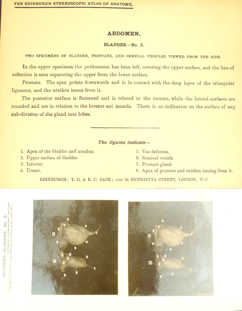 TWO SPECIMENS OF BLADDER, PROSTATE, AND SEMINAL VESICLES VIEWED FROM THE SIDE. In the upper specimen the peritoneum has been left, covering the upper surface, and the line of reflection is seen separating the upper from the lower surface. Prostate. The apex points downwards and is in contact with the deep layer of the triangular ligament, and the urethra issues from it. The posterior surface is flattened and is related to the rectum, while the lateral surfaces are rounded and are in relation to the levator ani muscle. There is no indication on the surface of any sub-division of the gland into lobes. 1. Apex of the bladder and urachus. 5. Yas deferens. 2. Upper surface of bladder. 6. Seminal vesicle 4. Ureter. 8. Apex of prostate and urethra issuing from it.