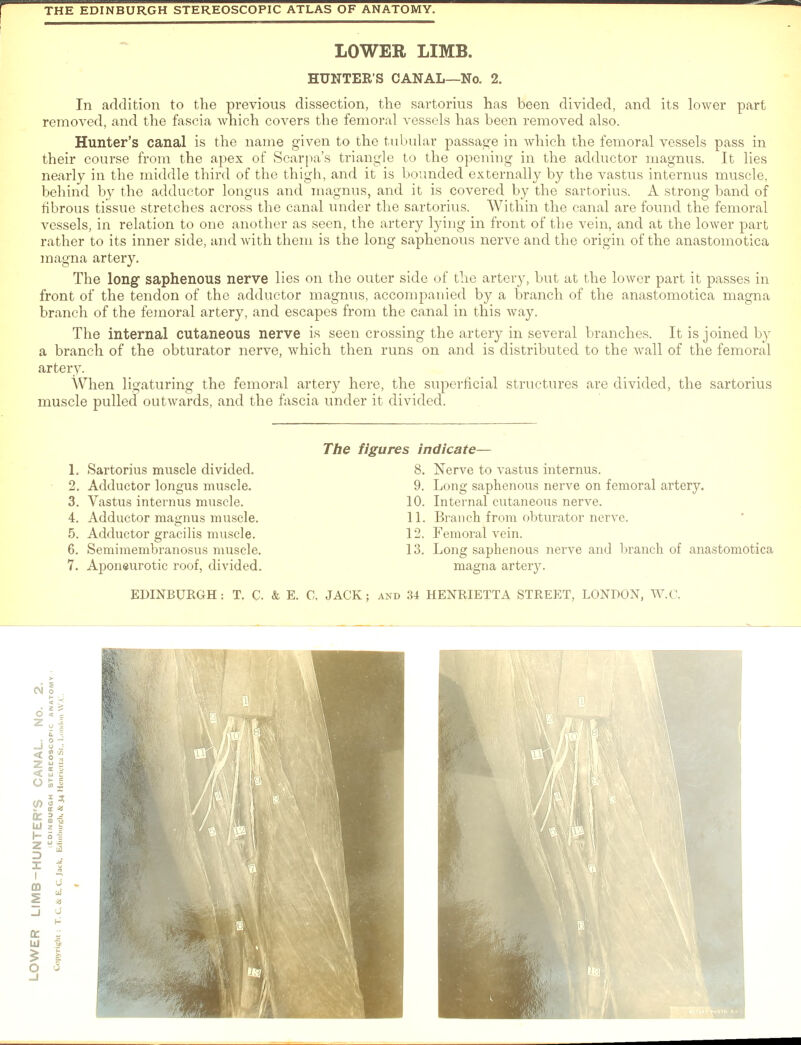 r THE EDINBURGH STEREOSCOPIC ATLAS OF ANATOMY. LOWER LIMB. HUNTER’S CANAL—No. 2. In addition to the previous dissection, the sartorius has been divided, and its lower part removed, and the fascia which covers the femoral vessels has been removed also. Hunter’s canal is the name given to the tubular passage in which the femoral vessels pass in their course from the apex of Scarpa’s triangle to the opening in the adductor magnus. It lies nearly in the middle third of the thigh, and it is bounded externally by the vastus internus muscle, behind by the adductor longus and magnus, and it is covered by the sartorius. A strong band of fibrous tissue stretches across the canal under the sartorius. Within the canal are found the femoral vessels, in relation to one another as seen, the artery lying in front of the vein, and at the lower part rather to its inner side, and with them is the long saphenous nerve and the origin of the anastomotica magna artery. The long saphenous nerve lies on the outer side of the artery, but at the lower part it passes in front of the tendon of the adductor magnus, accompanied by a branch of the anastomotica magna branch of the femoral artery, and escapes from the canal in this way. The internal cutaneous nerve is seen crossing the artery in several branches. It is joined by a branch of the obturator nerve, which then runs on and is distributed to the wall of the femoral artery. When ligaturing the femoral artery here, the superficial structures are divided, the sartorius muscle pulled outwards, and the fascia under it divided. 1. Sartorius muscle divided. 2. Adductor longus muscle. 3. Vastus internus muscle. 4. Adductor magnus muscle. 5. Adductor gracilis muscle. 6. Semimembranosus muscle. 7. Aponeurotic roof, divided. The figures indicate— 8. Nerve to vastus internus. 9. Long saphenous nerve on femoral artery. 10. Internal cutaneous nerve. 11. Branch from obturator nerve. 12. Femoral vein. 13. Long saphenous nerve and branch of anastomotica magna artery.