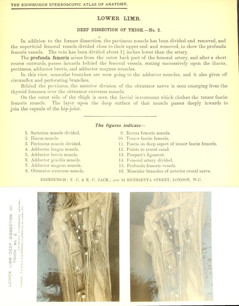 LOWER LIMB. DEEP DISSECTION OF THIGH.—No. 2. In addition to the former dissection, the pectineus muscle has been divided and removed, and the superficial femoral vessels divided close to their upper end and removed, to show the profunda femoris vessels. The vein has been divided about 1J inches lower than the artery. The profunda femoris arises from the outer back part of the femoral artery, and after a short course outwards, passes inwards behind the femoral vessels, resting successively upon the iliacus, pectineus, adductor brevis, and adductor magnus muscles. In this view, muscular branches are seen going to the adductor muscles, and it also gives off circumflex and perforating branches. Behind the pectineus, the anterior division of the obturator nerve is seen emerging from the thyroid foramen over the obturator externus muscle. On the outer side of the thigh is seen the fascial investment which clothes the tensor fasciae femoris muscle. The layer upon the deep surface of that muscle passes deeply inwards to join the capsule of the hip-joint. 1. Sartorius muscle divided. 2. Iliacus muscle. 3. Pectineus muscle divided. 4. Adductor longus muscle. 5. Adductor brevis muscle. 6. Adductor gracilis muscle. 7. Adductor magnus muscle. 8. Obturator externus muscle. The figures indicate— 9. Eectus femoris muscle. 10. Tensor fasciae femoris. 11. Fascia on deep aspect of tensor fasciae femoris. 12. Points to crural canal. 13. Poupart’s ligament. 14. Femoral artery divided. 15. Profunda femoris vessels. 16. Muscular branches of anterior crural nerve.