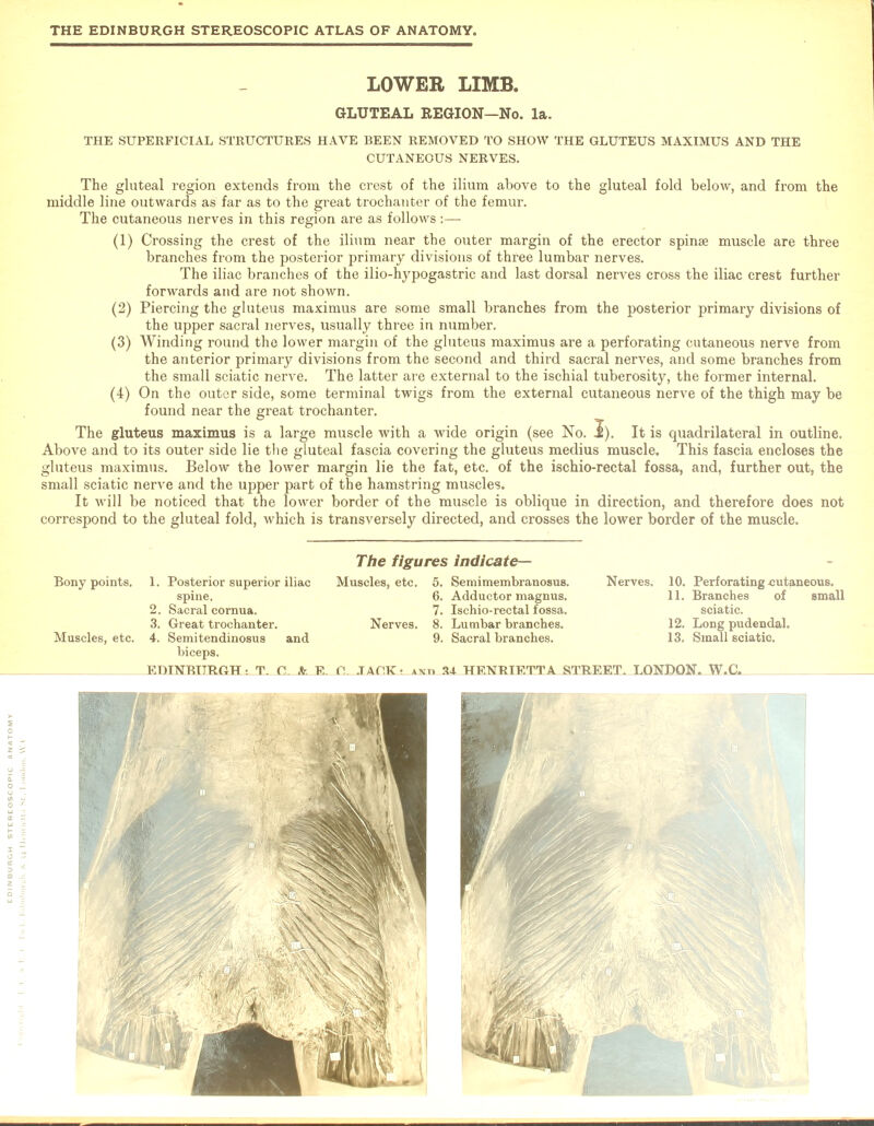 LOWER LIMB. GLUTEAL REGION—No. la. THE SUPERFICIAL STRUCTURES HAVE BEEN REMOVED TO SHOW THE GLUTEUS MAXIMUS AND THE CUTANEOUS NERVES. The gluteal region extends from the crest of the ilium above to the gluteal fold below, and from the middle line outwards as far as to the great trochanter of the femur. The cutaneous nerves in this region are as follows :—- (1) Crossing the crest of the ilium near the outer margin of the erector spinse muscle are three branches from the posterior primary divisions of three lumbar nerves. The iliac branches of the ilio-hypogastric and last dorsal nerves cross the iliac crest further forwards and are not shown. (2) Piercing the gluteus maximus are some small branches from the posterior primary divisions of the upper sacral nerves, usually three in number. (3) Winding round the lower margin of the gluteus maximus are a perforating cutaneous nerve from the anterior primary divisions from the second and third sacral nerves, and some branches from the small sciatic nerve. The latter are external to the ischial tuberosity, the former internal. (4) On the outer side, some terminal twigs from the external cutaneous nerve of the thigh may be found near the great trochanter. The gluteus maximus is a large muscle with a wide origin (see No. 1). It is quadrilateral in outline. Above and to its outer side lie the gluteal fascia covering the gluteus medius muscle. This fascia encloses the gluteus maximus. Below the lower margin lie the fat, etc. of the ischio-rectal fossa, and, further out, the small sciatic nerve and the upper part of the hamstring muscles. It will be noticed that the lower border of the muscle is oblique in direction, and therefore does not correspond to the gluteal fold, which is transversely directed, and crosses the lower border of the muscle. Bony points. 1. Posterior superior iliac spine. 2. Sacral cornua. 3. Great trochanter. Muscles, etc. 4. Semitendinosus and biceps. EDINBURGH - T. f! * The figures indicate— Muscles, etc. 5. Semimembranosus. 6. Adductor magnus. 7. Ischio-rectal fossa. Nerves. 8. Lumbar branches. 9. Sacral branches. L XLALAGK t anti 34 HENRIETTA S' Nerves. 10. Perforating cutaneous. 11. Branches of small sciatic. 12. Long pudendal. 13. Small sciatic. SET. LONDON. W.C.