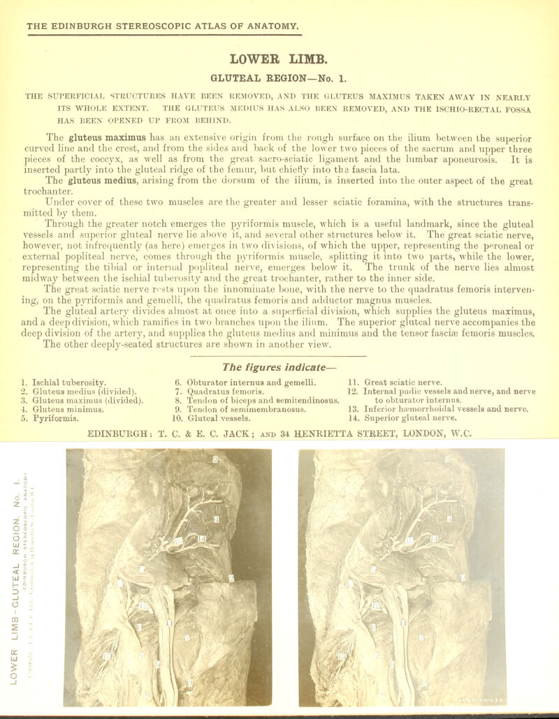 THE SUPERFICIAL STRUCTURES HAVE BEEN REMOVED, AND THE GLUTEUS MAXIMUS TAKEN AWAY IN NEARLY ITS WHOLE EXTENT. THE GLUTEUS MEDIUS HAS ALSO BEEN REMOVED, AND THE ISCHIO-RECTAL FOSSA HAS BEEN OPENED UP FROM BEHIND. The gluteus maximus has an extensive origin from the rough surface on the ilium between the superior curved line and the crest, and from the sides and back of the lower two pieces of the sacrum and upper three pieces of the coccyx, as well as from the great sacro-sciatic ligament and the lumbar aponeurosis. It is inserted partly into the gluteal ridge of the femur, but chiefly into the fascia lata. The gluteus medius, arising from the dorsum of the ilium, is inserted into the outer aspect of the great trochanter. Under cover of these two muscles are the greater and lesser sciatic foramina, with the structures trans- mitted by them. Through the greater notch emerges the pyriformis muscle, which is a useful landmark, since the gluteal vessels and superior gluteal nerve lie above it, and several other structures below it. The great sciatic nerve, however, not infrequently (as here) emerges in two divisions, of which the upper, representing the peroneal or external popliteal nerve, comes through the pyriformis muscle, splitting it into two parts, while the lower, representing the tibial or internal popliteal nerve, emerges below it. The trunk of the nerve lies almost midway between the ischial tuberosity and the great trochanter, rather to the inner side. The great sciatic nerve rests upon the innominate bone, with the nerve to the quadratus femoris interven- ing, on the pyriformis and gemelli, the quadratus femoris and adductor magnus muscles. The gluteal artery divides almost at once into a superficial division, which supplies the gluteus maximus, and a deep division, which ramifies in two branches upon the ilium. The superior gluteal nerve accompanies the deep division of the artery, and supplies the gluteus medius and minimus and the tensor fasciae femoris muscles. The other deeply-seated structures are shown in another view. 3. Gluteus maximus (divided). 5. Pyriformis. 8. Tendon of biceps and semitendinosus. 10. Gluteal vessels. to obturator internus. 14. Superior gluteal nerve.