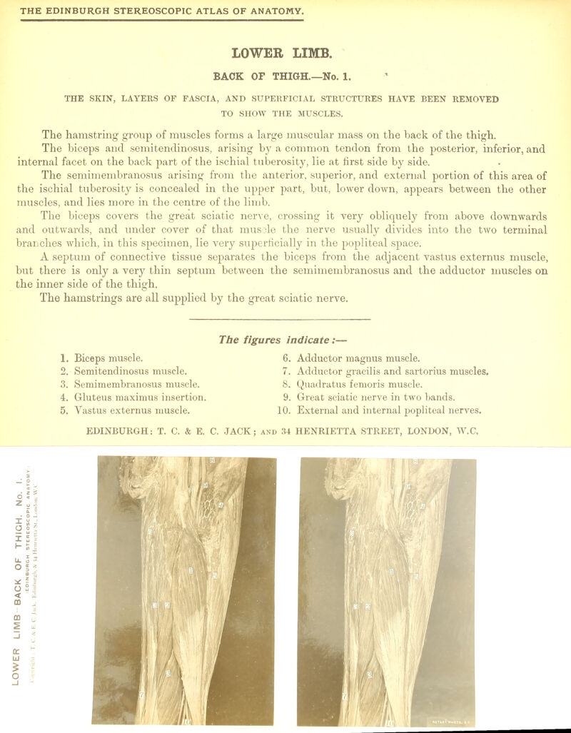 LOWER LIMB. BACK OF THIGH.—No. 1. THE SKIN, LAYERS OF FASCIA, AND SUPERFICIAL STRUCTURES HAVE BEEN REMOVED TO SHOW THE MUSCLES. The hamstring group of muscles forms a large muscular mass on the back of the thigh. The biceps and semitendinosus, arising by a common tendon from the posterior, inferior, and internal facet on the back part of the ischial tuberosity, lie at first side by side. The semimembranosus arising from the anterior, superior, and external portion of this area of the ischial tuberosity is concealed in the upper part, but, lower down, appears between the other muscles, and lies more in the centre of the limb. The biceps covers the great sciatic nerve, crossing it very obliquely from above downwards and outwards, and under cover of that muscle the nerve usually divides into the two terminal branches which, in this specimen, lie very superficially in the popliteal space. A septum of connective tissue separates the biceps from the adjacent vastus externus muscle, but there is only a very thin septum between the semimembranosus and the adductor muscles on the inner side of the thigh. The hamstrings are all supplied by the great sciatic nerve. The figures indicate 1. Biceps muscle. 2. Semitendinosus muscle. 3. Semimembranosus muscle. 4. Gluteus maximus insertion. 5. Yastus externus muscle. 6. Adductor magnus muscle. 7. Adductor gracilis and sartorius muscles. 8. Quaclratus femoris muscle. 9. Great sciatic nerve in two bands. 10. External and internal popliteal nerves.