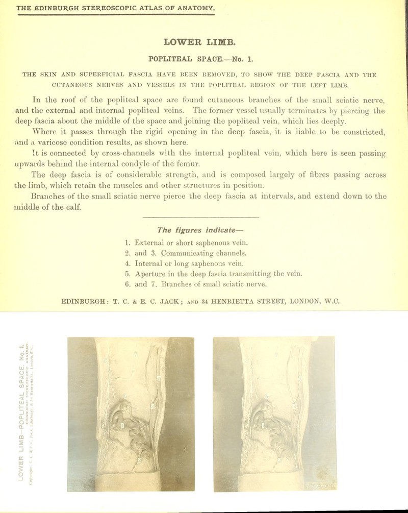 LOWER LIMB. POPLITEAL SPACE.—No. 1. THE SKIN AND SUPERFICIAL FASCIA HAVE BEEN REMOVED, TO SHOW THE DEEP FASCIA AND THE CUTANEOUS NERVES AND VESSELS IN THE POPLITEAL REGION OF THE LEFT LIMB. In. the roof of the popliteal space are found cutaneous branches of the small sciatic nerve, and the external and internal popliteal veins. The former vessel usually terminates by piercing the deep fascia about the middle of the space and joining the popliteal vein, which lies deeply. Where it passes through the rigid opening in the deep fascia, it is liable to be constricted, and a varicose condition results, as shown here. It is connected by cross-channels with the internal popliteal vein, which here is seen passing upwards behind the internal condyle of the femur. The deep fascia is of considerable strength, and is composed largely of fibres passing across the limb, which retain the muscles and other structures in position. Branches of the small sciatic nerve pierce the deep fascia at intervals, and extend down to the middle of the calf. The figures indicate— 1. External or short saphenous vein. 2. and 3. Communicating channels. 4. Internal or long saphenous vein. 5. Aperture in the deep fascia transmitting the vein. 6. and 7. Branches of small sciatic nerve.