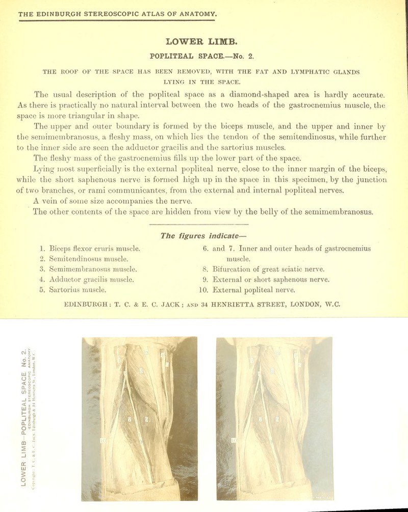 LOWER LIMB. POPLITEAL SPACE.—No. 2. THE ROOF OF THE SPACE HAS BEEN REMOVED, WITH THE FAT AND LYMPHATIC GLANDS LYING IN THE SPACE. The usual description of the popliteal space as a diamond-shaped area is hardly accurate. As there is practically no natural interval between the two heads of the gastrocnemius muscle, the space is more triangular in shape. The upper and outer boundary is formed by the biceps muscle, and the upper and inner by the semimembranosus, a fleshy mass, on which lies the tendon of the semitendinosus, while further to the inner side are seen the adductor gracilis and the sartorius muscles. The fleshy mass of the gastrocnemius fills up the lower part of the space. Lying most superficially is the external popliteal nerve, close to the inner margin of the biceps, while the short saphenous nerve is formed high up in the space in this specimen, by the junction of two branches, or rami communicantes, from the external and internal popliteal nerves. A vein of some size accompanies the nerve. The other contents of the space are hidden from view by the belly of the semimembranosus. 1. Biceps flexor cruris muscle. 2. Semitendinosus muscle. 3. Semimembranosus muscle. 4. Adductor gracilis muscle. 5. Sartorius muscle. The figures indicate— 6. and 7. Inner and outer heads of gastrocnemius muscle. 8. Bifurcation of great sciatic nerve. 9. External or short saphenous nerve. 10. External popliteal nerve.