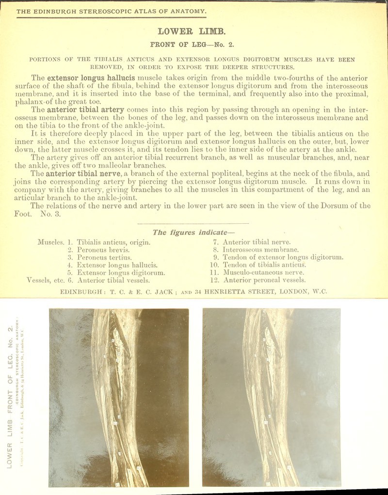 PORTIONS OF THE TIBIALIS ANTICUS AND EXTENSOR LONGUS DIGITORUM MUSCLES HAVE BEEN REMOVED, IN ORDER TO EXPOSE THE DEEPER STRUCTURES. The extensor longus hallucis muscle takes origin from the middle two-fourths of the anterior surface of the shaft of the fibula, behind the extensor longus digitorum and from the interosseous membrane, and it is inserted into the base of the terminal, and frequently also into the proximal, phalanx-of the great toe. The anterior tibial artery comes into this region by passing through an opening in the inter- osseus membrane, between the bones of the leg, and passes down on the interosseus membrane and on the tibia to the front of the ankle-joint. It is therefore deeply placed in the upper part of the leg, between the tibialis anticus on the inner side, and the extensor longus digitorum and extensor longus hallucis on the outer, but, lower down, the latter muscle crosses it, and its tendon lies to the inner side of the artery at the ankle. The artery gives off an anterior tibial recurrent branch, as well as muscular branches, and, near the ankle, gives off two malleolar branches. The anterior tibial nerve, a branch of the external popliteal, begins at the neck of the fibula, and joins the corresponding artery by piercing the extensor longus digitorum muscle. It runs down in company with the artery, giving branches to all the muscles in this compartment of the leg, and an articular branch to the ankle-joint. The relations of the nerve and artery in the lower part are seen in the view of the Dorsum of the Foot. No. 3. o Peroneus brevis. 8. Interosseous membrane.