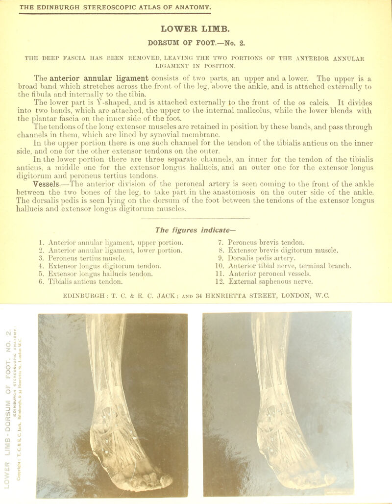 THE DEEP FASCIA HAS BEEN REMOVED, LEAVING THE TWO PORTIONS OF THE ANTERIOR ANNULAR LIGAMENT IN POSITION. The anterior annular ligament consists of two parts, an upper and a lower. The upper is a broad band which stretches across the front of the leg, above the ankle, and is attached externally to the fibula and internally to the tibia. The lower part is Y-shaped, and is attached externally to the front of the os calcis. It divides into two bands, which are attached, the upper to the internal malleolus, while the lower blends with the plantar fascia on the inner side of the foot. The tendons of the long extensor muscles are retained in position by these bands, and pass through channels in them, which are lined by synovial membrane. In the upper portion there is one such channel for the tendon of the tibialis anticus on the inner side, and one for the other extensor tendons on the outer. In the lower portion there are three separate channels, an inner for the tendon of the tibialis anticus, a middle one for the extensor longus hallucis, and an outer one for the extensor longus digitorum and peroneus tertius tendons. Vessels.—The anterior division of the peroneal artery is seen coming to the front of the ankle between the two bones of the leg, to take part in the anastomosis on the outer side of the ankle. The dorsalis pedis is seen lying on the dorsum of the foot between the tendons of the extensor longus hallucis and extensor longus digitorum muscles.