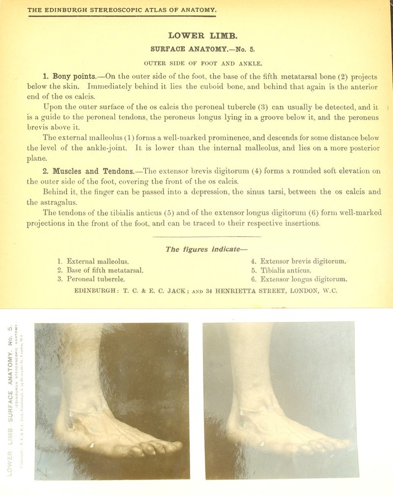 1. Bony points.—On the outer side of the foot, the base of the fifth metatarsal bone (2) projects below the skin. Immediately behind it lies the cuboid bone, and behind that again is the anterior Upon the outer surface of the os calcis the peroneal tubercle (3) can usually be detected, and it l The external malleolus (1) forms a well-marked prominence, and descends for some distance below the level of the ankle-joint. It is lower than the internal malleolus, and lies on a more posterior plane. the outer side of the foot, covering the front of the os calcis. Behind it, the finger can be passed into a depression, the sinus tarsi, between the os calcis and the astragalus. The tendons of the tibialis anticus (5) and of the extensor longus digitorum (6) form well-marked projections in the front of the foot, and can be traced to their respective insertions. 2. Base of fifth metatarsal. 5. Tibialis anticus. 3. Peroneal tubercle. 6. Extensor longus digitorum. if)