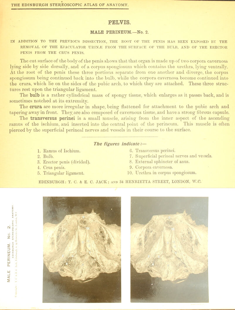 PELVIS. MALE PERINEUM.—No. 2. IN ADDITION TO THE PREVIOUS DISSECTION, THE ROOT OF THE PENIS HAS BEEN EXPOSED BY THE REMOVAL OF THE EJACULATOR URIN^E FROM THE SURFACE OF THE BULB, AND OF THE ERECTOR PENIS FROM THE CRUS PENIS. The cut surface of the body of the penis shows that that organ is made up of two corpora cavernosa lying side by side dorsally, and of a corpus spongiosum which contains the urethra, lying ventrally. At the root of the penis these three portions separate from one another and diverge, the corpus spongiosum being continued back into the bulb, while the corpora cavernosa become continued into the crura, which lie on the sides of the pubic arch, to which they are attached. These three struc- tures rest upon the triangular ligament. The bulb is a rather cylindrical mass of spongy tissue, which enlarges as it passes back, and is sometimes notched at its extremity. The crura are more irregular in shape, being flattened for attachment to the pubic arch and tapering away in front. They are also composed of cavernous tissue, and have a strong fibrous capsule. The transversus perinei is a small muscle, arising from the inner aspect of the ascending ramus of the ischium, and inserted into the central point of the perineum. This muscle is often pierced by the superficial perineal nerves and vessels in their course to the surface. The figures indicate :— 1. Ramus of Ischium. 6. Transversus perinei. 2. Bulb. 7. Superficial perineal nerves and vessels. 3. Erector penis (divided). 8. External sphincter of anus. 4. Crus penis. 9. Corpora cavernosa. 5. Triangular ligament. 10. Urethra in corpus spongiosum.