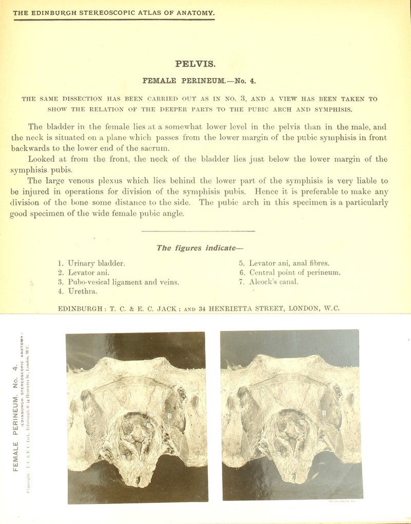 PELVIS. FEMALE PERINEUM. —No. 4. THE SAME DISSECTION HAS BEEN CARRIED OUT AS IN NO. 3, AND A VIEW HAS BEEN TAKEN TO SHOW THE RELATION OF THE DEEPER PARTS TO THE PUBIC ARCH AND SYMPHISIS. The bladder in the female lies at a somewhat lower level in the pelvis than in the male, and the neck is situated on a plane which passes from the lower margin of the pubic symphisis in front backwards to the lower end of the sacrum. Looked at from the front, the neck of the bladder lies just below the lower margin of the symphisis pubis. The large venous plexus which lies behind the lower part of the symphisis is very liable to be injured in operations for division of the symphisis pubis. Hence it is preferable to make any division of the bone some distance to the side. The pubic arch in this specimen is a particularly good specimen of the wide female pubic angle. The figures indicate— 1. Urinary bladder. 2. Levator ani. 3. Pubo-vesical ligament and veins. 4. Urethra. 5. Levator ani, anal fibres. 6. Central point of perineum. 7. Alcock's canal.