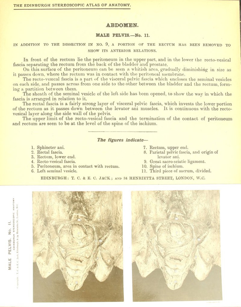 ABDOMEN. MALE PELVIS.—No. 11. IN ADDITION TO THE DISSECTION IN NO. 9, A PORTION OF THE RECTUM HAS BEEN REMOVED TO SHOW ITS ANTERIOR RELATIONS. In front of the rectum lie the peritoneum in the upper part, and in the lower the recto-vesical fascia separating the rectum from the back of the bladder and prostate. On this surface of the peritoneum can be seen a whitish area, gradually diminishing in size as it passes down, where the rectum was in contact with the peritoneal membrane. The recto-vesical fascia is a part of the visceral pelvic fascia which encloses the seminal vesicles on each side, and passes across from one side to the other between the bladder and the rectum, form- ing a partition between them. The sheath of the seminal vesicle of the left side has been opened, to show the way in which the fascia is arranged in relation to it. The rectal fascia is a fairly strong layer of visceral pelvic fascia, which invests the lower portion of the rectum as it passes down between the levator ani muscles. It is continuous with the recto- vesical layer along the side wall of the pelvis. The upper limit of the recto-vesical fascia and the termination of the contact of peritoneum and rectum are seen to be at the level of the spine of the ischium. The figures indicate 1. Sphincter ani. 2. Rectal fascia. 3. Rectum, lower end. 4. Recto-vesical fascia. 5. Peritoneum, area in contact with rectum. 6. Left seminal vesicle. 7. Rectum, upper end. 8. Parietal pelvic fascia, and origin of levator ani. 9. Great sacro-sciatic ligament. 10. Spine of ischium. 11. Third piece of sacrum, divided.