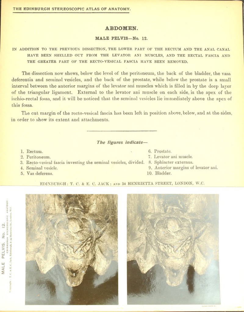 ABDOMEN. MALE PELVIS—No. 12. IN ADDITION TO THE PREVIOUS DISSECTION, THE LOWER PART OF THE RECTUM AND THE ANAL CANAL HAVE BEEN SHELLED OUT FROM THE LEVATOR ANI MUSCLES, AND THE RECTAL FASCIA AND THE GREATER PART OF THE RECTO-VESICAL FASCIA HAVE BEEN REMOVED. The dissection now shows, below the level of the peritoneum, the back of the bladder, the vasa deferentia and seminal vesicles, and the back of the prostate, while below the prostate is a small interval between the anterior margins of the levator ani muscles which is filled in by the deep layer of the triangular ligament. External to the levator ani muscle on each side, is the apex of the ischio-rectal fossa, and it will be noticed that the seminal vesicles lie immediately above the apex of this fossa. The cut margin of the recto-vesical fascia has been left in position above, below, and at the sides, in order to show its extent and attachments. The figures indicate— 1. Rectum. • 6. Prostate. 2. Peritoneum. 7. Levator ani muscle. 3. Recto-vesical fascia investing the seminal vesicles, divided. 8. Sphincter externus. 4. Seminal vesicle. 9. Anterior margins of levator ani. 5. Vas deferens. 10. Bladder.