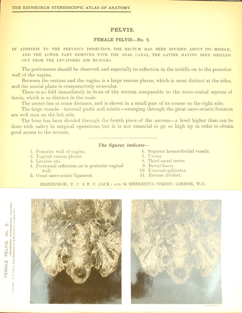 PELVIS. FEMALE PELVIS—No. 2. IN ADDITION TO THE PREVIOUS DISSECTION, THE RECTUM HAS BEEN DIVIDED ABOUT ITS MIDDLE, AND THE LOWER PART REMOVED WITH THE ANAL CANAL, THE LATTER HAVING BEEN SHELLED OUT FROM THE LEVATORES ANI MUSCLES. The peritoneum should be observed, and especially its reflection in the middle on to the posterior wall of the vagina. Between the rectum and the vagina is a large venous plexus, which is most distinct at the sides, and the mesial plane is comparatively avascular. There is no fold immediately in front of the rectum comparable to the recto-vesical septum of fascia, which is so distinct in the male. The ureter lies at some distance, and is shown in a small part of its course on the right side. The large vessels—internal pudic and sciatic—emerging through the great sacro-sciatic foramen are well seen on the left side. The bone has been divided through the fourth piece of the sacrum—a level higher than can be done with safety in surgical operations, but it is not essential to go so high up in order to obtain good access to the rectum. The figures indicate— 5. G-reat sacro-sciatic ligament. 1. Posterior wall of vagina. 2. Vaginal venous plexus. 3. Levator ani. 4. Peritoneal reflection on to posterior vaginal wall. G. Superior hemorrhoidal vessels. 7. Ureter. 8. Third sacral nerve. 9. Rectal fascia. 10. External sphincter. 11. Rectum divided.