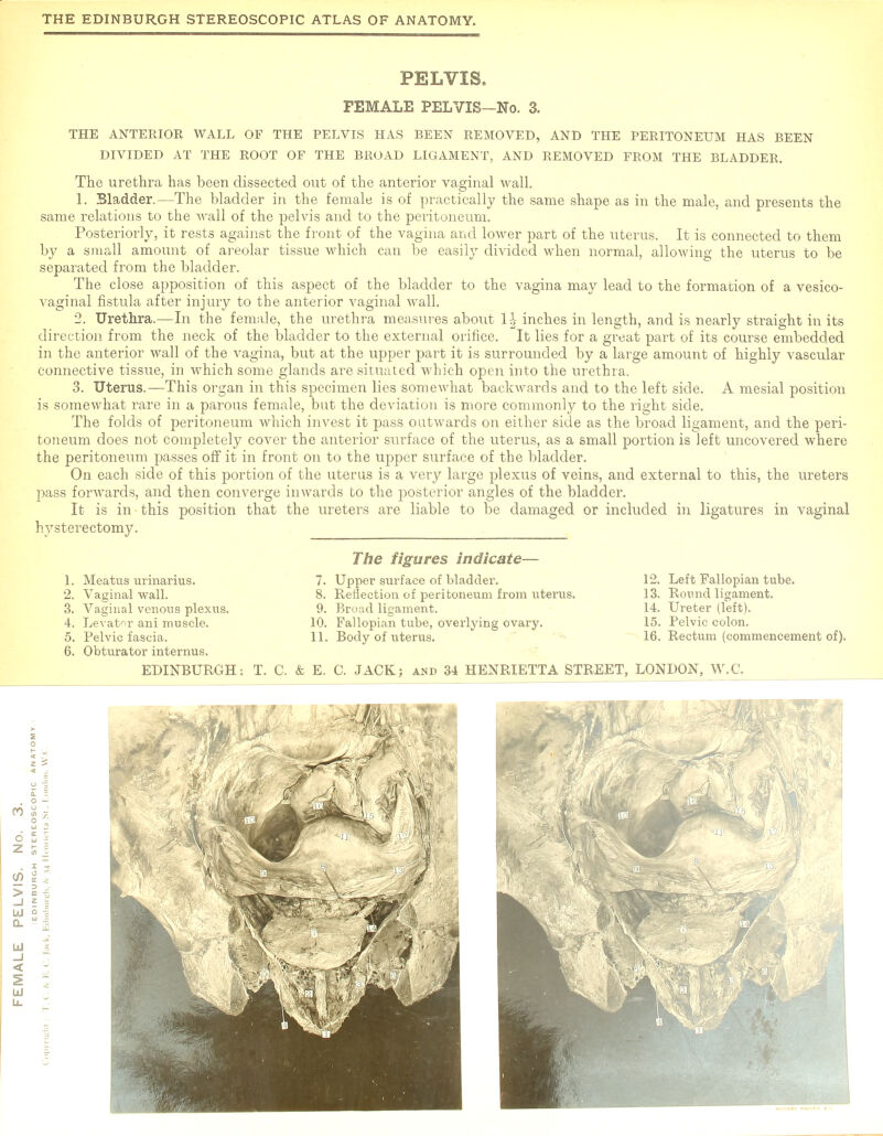 PELVIS. FEMALE PELVIS-No. 3. THE ANTERIOR WALL OF THE PELVIS HAS BEEN REMOVED, AND THE PERITONEUM HAS BEEN DIVIDED AT THE ROOT OF THE BROAD LIGAMENT, AND REMOVED FROM THE BLADDER. The urethra has been dissected out of the anterior vaginal wall. 1. Bladder.—The bladder in the female is of practically the same shape as in the male, and presents the same relations to the Avail of the pelvis and to the peritoneum. Posteriorly, it rests against the front of the vagina and lower part of the uterus. It is connected to them by a small amount of areolar tissue which can be easily divided when normal, allowing the uterus to be separated from the bladder. The close apposition of this aspect of the bladder to the vagina may lead to the formation of a vesico- vaginal fistula after injury to the anterior vaginal wall. '2. Urethra.—In the female, the urethra measures about 1J inches in length, and is nearly straight in its direction from the neck of the bladder to the external orifice. It lies for a great part of its course embedded in the anterior wall of the vagina, but at the upper part it is surrounded by a large amount of highly vascular connective tissue, in which some glands are situated which open into the urethra. 3. Uterus.—This organ in this specimen lies somewhat backwards and to the left side. A mesial position is somewhat rare in a parous female, but the deviation is more commonly to the right side. The folds of peritoneum which invest it pass outwards on either side as the broad ligament, and the peri- toneum does not completely cover the anterior surface of the uterus, as a small portion is left uncovered where the peritoneum passes off it in front on to the upper surface of the bladder. On each side of this portion of the uterus is a very large plexus of veins, and external to this, the ureters pass forwards, and then converge inwards to the posterior angles of the bladder. It is in this position that the ureters are liable to be damaged or included in ligatures in vaginal hysterectomy. 1. Meatus urinarius. 2. Vaginal wall. 3. Vaginal venous plexus. 4. Levator ani muscle. 5. Pelvic fascia. 6. Obturator internus. The figures indicate— 7. Upper surface of bladder. 8. Reflection of peritoneum from uterus. 9. Broad ligament. 10. Fallopian tube, overlying ovary. 11. Body of uterus. 12. Left Fallopian tube. 13. Round ligament. 14. Ureter (left). 15. Pelvic colon. 16. Rectum (commencement of).