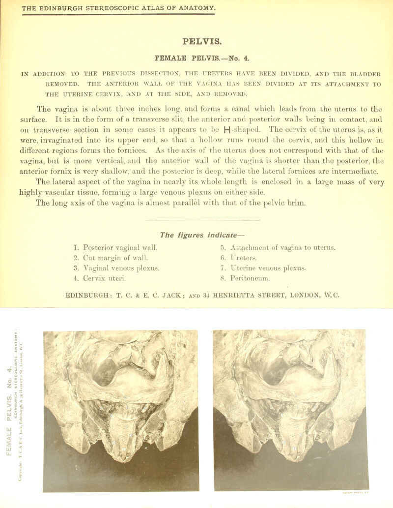 PELVIS. FEMALE PELVIS.—No. 4. IN ADDITION TO THE PREVIOUS DISSECTION, THE URETERS HAVE BEEN DIVIDED, AND THE BLADDER REMOVED. THE ANTERIOR WALL OF THE VAGINA HAS BEEN DIVIDED AT ITS ATTACHMENT TO THE UTERINE CERVIX, AND AT THE SIDE, AND REMOVED. The vagina is about three inches long, and forms a canal which leads from the uterus to the surface. It is in the form of a transverse slit, the anterior and posterior walls being in contact, and on transverse section in some cases it appears to be H-shaped. The cervix of the uterus is, as it were, invaginated into its upper end, so that a hollow runs round the cervix, and this hollow in different regions forms the fornices. As the axis of the uterus does not correspond with that of the vagina, but is more vertical, and the anterior wall of the vagina is shorter than the posterior, the anterior fornix is very shallow, and the posterior is deep, while the lateral fornices are intermediate. The lateral aspect of the vagina in nearly its whole length is enclosed in a large mass of very highly vascular tissue, forming a large venous plexus on either side. The long axis of the vagina is almost parallel with that of the pelvic brim. The figures indicate— 1. Posterior vaginal wall. 2. Cut margin of wall. 3. Vaginal venous plexus, 4. Cervix uteri. 5. Attachment of vagina to uterus. 6. Ureters. 7. Uterine venous plexus. 8. Peritoneum.