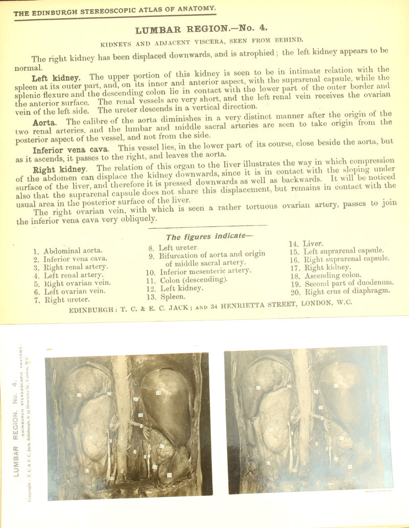 LUMBAR REGXON.-No. 4. KIDNEYS AND ADJACENT VISCERA, SEEN FROM BEHIND. The right kidney has been displaced downwards, and is atrophied; the left kidney appears to be n0rma1' m «f Vidnpv is seen to be in intimate relation with the Left kidney. The upper portion of J^\^^ the suprarenal capsule, while the spleen at its outer part, and, on its inner ^.^^t^\^\oxrei part of the oiiter border and SSSSSa- ■*--7 r 2 ^C^MSStT^ a rather tortuous ovarian artery, passes to join the inferior vena cava very obliquely. 1. Abdominal aorta. 2. Inferior vena cava. 3. Right renal artery. 4. Left renal artery. 5. Kight ovarian vein. 6. Left ovarian vein. 7. Right ureter. EDINBURGH T. C. The figures indicate— 8. Left ureter. 9. Bifurcation of aorta and origin of middle sacral artery. 10. Inferior mesenteric artery. 11. Colon (descending). 12. Left kidney. 13. Spleen. & E. C. JACK 14. Liver. 15. Left suprarenal capsule. 16. Right suprarenal capsule. 17. Right kidney. 18. Ascending colon. 19. Second part of duodenum. 20. Right crus of diaphragm. nd 34 HENRIETTA STREET, LONDON, W.C.