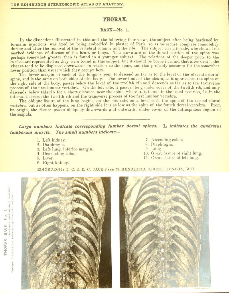 THORAX. BACK—No. 1. In the dissections illustrated in this and the following four views, the subject after being hardened by formalin injections, was fixed by being embedded in plaster of Paris, so as to secure complete immobility during and after the removal of the vertebral column and the ribs. The subject was a female, who showed no marked evidence of disease of the heart or lungs. The curvature of the dorsal portion of the spine was perhaps somewhat greater than is found in a younger subject. The relations of the deeper parts to the surface are represented as they were found in this subject, but it should be borne in mind that after death, the viscera tend to be displaced downwards in relation to the spine, and this probably accounts for the somewhat lower position than usual which they occupy here. The lower margin of each of the lungs is seen to descend as far as to the level of the eleventh dorsal spine, and is the same on both sides of the body. The lower limit of the pleura, as it approaches the spine on the right side of the body, passes below the level of the twelfth rib and descends as far as to the transverse process of the first lumbar vertebra. On the left side, it passes along under cover of the twelfth rib, and only descends below this rib for a short distance near the spine, where it is found in the usual position, i.e. in the interval between the twelfth rib and the transverse process of the first lumbar vertebra. The oblique fissure of the lung begins, on the left side, on a level with the spine of the second dorsal vertebra, but as often happens, on the right side it is as low as the spine of the fourth dorsal vertebra. From its origin, the fissure passes obliquely downwards and outwards, under cover of the infraspinous region of the scapula. Large numbers indicate corresponding lumbar dorsal spines. L indicates the quadratus iu mho rum muscle. The small numbers indicate— 1. Left kidney. 2. Diaphragm. 3. Left lung, inferior margin 4. Descending colon. 5. Liver. 6. Right kidney. EDINBURGH: T. C. & E. C. JACK ; and .34 HENRIETTA STREET, LONDON, W.C. 7. Ascending colon. 8. Diaphragm. 9. Lung. 10. Great fissure of right lung. 11. Great fissure of left lung.