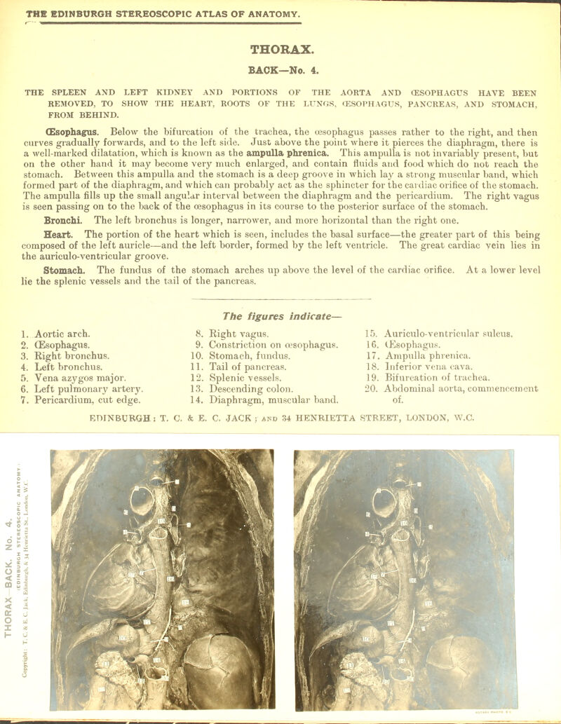 THORAX. BACK—No. 4. THE SPLEEN AND LEFT KIDNEY AND POKTIONS OF THE AORTA AND (ESOPHAGUS HAVE BEEN REMOVED, TO SHOW THE HEART, ROOTS OF THE LUNGS, (ESOPHAGUS, PANCREAS, AND STOMACH, FROM BEHIND. (Esophagus. Below the bifurcation of the trachea, the oesophagus passes rather to the right, and then curves gradually forwards, and to the left side. Just above the point where it pierces the diaphragm, there is a well-marked dilatation, which is known as the ampulla phrenica. This ampulla is not invariably present, but on the other hand it may become very much enlarged, and contain fluids and food which do not reach the stomach. Between this ampulla and the stomach is a deep groove in which lay a strong muscular band, which formed part of the diaphragm, and which can probably act as the sphincter for the cardiac orifice of the stomach. The ampulla fills up the small angular interval between the diaphragm and the pericardium. The right vagus is seen passing on to the back of the oesophagus in its course to the posterior surface of the stomach. Bronchi. The left bronchus is longer, narrower, and more horizontal than the right one. Heart. The portion of the heart which is seen, includes the basal surface—the greater part of this being composed of the left auricle—and the left border, formed by the left ventricle. The great cardiac yein lies in the auriculo-ventricular groove. Stomach. The fundus of the stomach arches up above the level of the cardiac orifice. At a lower level lie the splenic vessels and the tail of the pancreas. The figures indicate— 1. Aortic arch. 2. (Esophagus. 3. Eight bronchus. 4. Left bronchus. 5. Vena azygos major. 6. Left pulmonary artery. 7. Pericardium, cut edge. 8. Right vagus. 9. Constriction on oesophagus. 10. Stomach, fundus. 11. Tail of pancreas. 12. Splenic vessels. 13. Descending colon. 14. Diaphragm, muscular band. 15. Auriculo-ventricular sulcus. 16. (Esophagus. 17. Ampulla phrenica. 18. Inferior vena cava. 19. Bifurcation of trachea. 20. Abdominal aorta, commencement of.