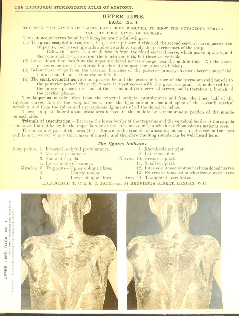 UPPER LIMB. BACK—No. 1. THE SKIN AND LAYERS OF FASCIA HAVE BEEN REMOVED, TO SHOW THE CUTANEOUS NERVES AND THE FIRST LAYER OF MUSCLES. The cutaneous nerves found in this region are the following:— (1) The great occipital nerve, from the posterior primary division of the second cervical nerve, pierces the trapezius, and passes upwards and outwards to supply the posterior part of the scalp. Below this nerve is a small branch from the third cervical nerve, which passes upwards, and then one small twig also from the fourth and fifth, but these are variable. (2) Lower down, branches from the upper six dorsal nerves emerge near the middle line. All the above nerves come from the internal branches of the posterior primary divisions. (3) Below these, twigs from the external branches of the posterior primary divisions become superficial, but at some distance from the middle line. (4) The small occipital nerve runs upwards behind the posterior border of the sterno-mastoid muscle to the posterior part of the scalp, where it anastomoses with the great occipital. It is derived from the anterior primary divisions of the second and third cervical nerves, and is therefore a branch of the cervical plexus. The trapezius muscle arises from the external occipital protuberance and from the inner half of the superior curved line of the occipital bone, from the ligamentum nucha} and spine of the seventh cervical vertebra, and from the spines and supraspinous ligaments of all the dorsal vertebrae. There is a quadrilateral aponeurotic area formed in the middle by a membranous portion of the muscle on each side. Triangle of auscultation.—Between the lower border of the trapezius and the vertebral border of the scapula is an area, limited below by the upper border of the latissimus dorsi, in which the rhomboideus major is seen. The remaining part of this area (14) is known as the triangle of auscultation, since in this region the chest wall i.s not covered by any thick mass of muscle, and therefore the lung sounds can be well heard here. The figures indicate:— Bony points. 1. External occipital protuberance. 8. Rhomboideus major. 2. Vertebra prominens. 9. Latissimus dorsi. 3. Spine of scapula. Nerves. 10. Qreat occipital. 4. Lower angle of scapula. 11. Small occipital. Muscles. 5. Trapezius—Upper oblique fibres. 12. Internal cutaneous branchesfromdorsal nerves. G. „ Central tendon. 13. Externalcutaneousbranchesfromdorsalnerves. 7. ,, Lower oblique fibres. Area. 14. Triangle of auscultation.