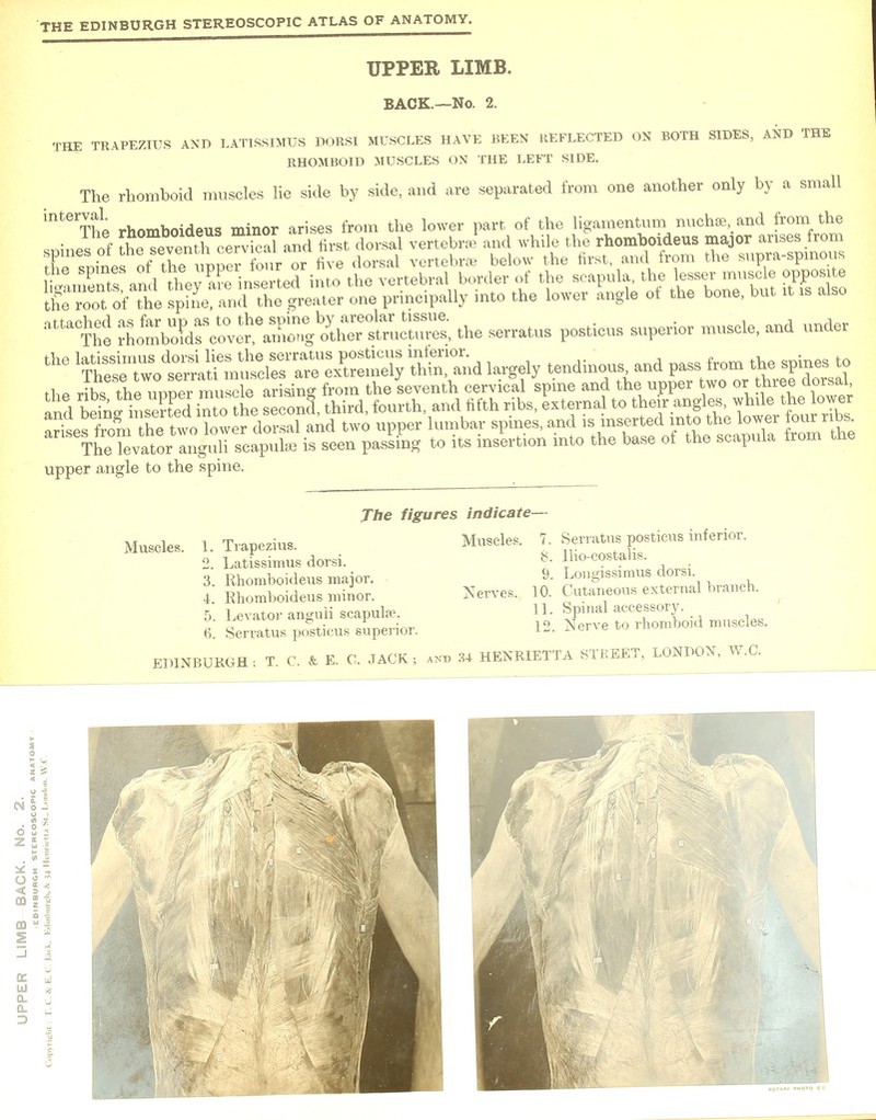 UPPER LIMB. BACK.—No. 2. THE TRAPEZIUS AND LATISSIMUS DORSI MUSCLES HAVE BEEN REFLECTED ON BOTH SIDES, AND THE RHOMBOID MUSCLES ON THE LEFT SIDE. The rhomboid muscles lie side by side, and are separated from one another only by a small inteThe rhomboideus minor arises from the lower part of the ligamentum nucha and from the .nines of ^^nt ceS and first dorsal vertebra! and while the rhomboideus major arises from ^D^en^upS^four or five dorsal vertebrae below the first, and from the supra-spmous kSments and thev are inserted into the vertebral border of the scapula, the lesser muscle opposite IrrTt ofThe spiL and the greater one principally into the lower angle ot the bone, but it is also attate ^^eZ^^^, the serratus posticus superior muscle, and under ^^M^^J^^^ largely tendinous, and pass from the spines to the ribsthe^Imper muse e arising from the Seventh cervical spine and the upper two or three dorsal and Mn~?S into the second, third, fourth and fifth ribs, external to angles whdc, t^l<™ arises from the two lower dorsal and two upper lumbar spines, and is inserted into the lower £^rite. The levator anguli scapula is seen passing to its insertion into the base of the scapula from the upper angle to the spine. The figures indicate- Muscles. 1. Trapezius. 2. Latissimus dorsi. 3. Rhomboideus major. 4. Rhomboideus minor. 5. Levator anguii scapula1. Serratus posticus superior. Muscles. 7. Serratus posticus inferior. 8. llio-costalis. 9. Longissimus dorsi. Nerves. 10. Cutaneous external branch. 11. Spinal accessory. 12 Nerve to rhomboid muscles.