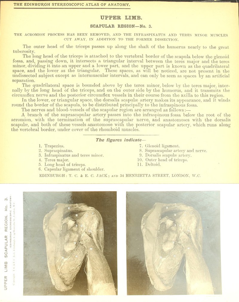 UPPER LIMB. SCAPULAR REGION—No. 3. THE ACROMION PROCESS HAS BEEN REMOVED, AND THE INFRASPINATUS AND TERES MINOR MUSCLES CUT AWAY, IN ADDITION TO THE FORMER DISSECTION. The outer head of the triceps passes up along the shaft of the humerus nearly to the great tuberosity. The long head of the triceps is attached to the vertebral border of the scapula below the glenoid fossa, and, passing down, it intersects a triangular interval between the teres major and the teres minor, dividing it into an upper and a lower part, and the upper part is known as the quadrilateral space, and the lower as the triangular. These spaces, as will be noticed, are not present in the undissected subject except as intermuscular intervals, and can only be seen as spaces by an artificial separation. The quadrilateral space is bounded above by the teres minor, below by the teres major, inter- nally by the long head of the triceps, and on the outer side by the humerus, and it transmits the circumflex nerve and the posterior circumflex vessels in their course from the axilla to this region. In the lower, or triangular space, the dorsalis scapulas artery makes its appearance, and it winds round the border of the scapula, to be distributed principally to the infraspinous fossa. The nerves and blood-vessels of the scapular region are arranged as follows:— A branch of the suprascapular artery passes into the infraspinous fossa below the root of the acromion, with the termination of the suprascapular nerve, and anastomoses with the dorsalis scapulas, and both of these vessels anastomose with the posterior scapular artery, which runs along the vertebral border, under cover of the rhomboid muscles. The figures indicate- 1. Trapezius. 2. Supraspinatus. 3. Infraspinatus and teres minor. 4. Teres major. 5. Long head of triceps. 6. Capsular ligament of shoulder. EDINBURGH: T. C. & E. C. JACK; and 34 HENRIETTA STREET, LONDON, W.C. 7. Glenoid ligament. 8. Suprascapular artery and nerve. 9. Dorsalis scapulas artery. 10. Outer head of triceps. 11. Deltoid.