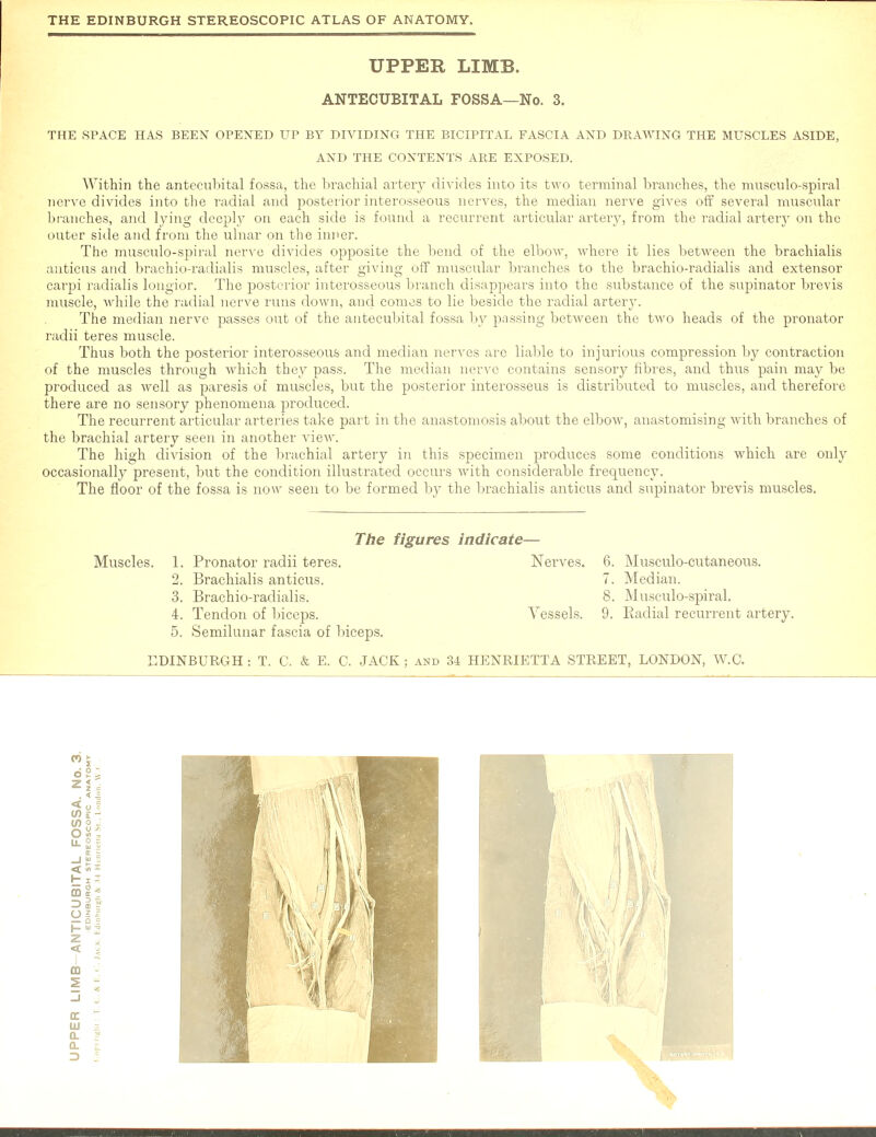 UPPER LIMB. ANTECUBITAL FOSSA—No. 3. THE SPACE HAS BEEN OPENED UP BY DIVIDING THE BICIPITAL FASCIA AND DRAWING THE MUSCLES ASIDE, AND THE CONTENTS ARE EXPOSED. Within the antecubital fossa, the brachial artery divides into its two terminal branches, the musculo-spiral nerve divides into the radial and posterior interosseous nerves, the median nerve gives off several muscular branches, and lying deeply on each side is found a recurrent articular artery, from the radial artery on the outer side and from the ulnar on the inner. The musculo-spiral nerve divides opposite the bend of the elbow, where it lies between the brachialis anticus and brachio-radialis muscles, after giving off muscular branches to the brachio-radialis and extensor carpi radialis longior. The posterior interosseous branch disappears into the substance of the supinator brevis muscle, while the radial nerve runs down, and comes to lie beside the radial artery. The median nerve passes out of the antecubital fossa by passing between the two heads of the pronator radii teres muscle. Thus both the posterior interosseous and median nerves arc liable to injurious compression by contraction of the muscles through Avhich they pass. The median nerve contains sensory fibres, and thus pain may be produced as well as paresis of muscles, but the posterior interosseus is distributed to muscles, and therefore there are no sensory phenomena produced. The recurrent articular arteries take part in the anastomosis about the elbow, anastomising with branches of the brachial artery seen in another view. The high division of the brachial artery in this specimen produces some conditions which are only occasionally present, but the condition illustrated occurs with considerable frequency. The floor of the fossa is now seen to be formed by the brachialis anticus and supinator brevis muscles. The figures indicate— Muscles. 1. Pronator radii teres. Nerves. 6. Musculocutaneous. 2. Brachialis anticus. 7. Median. 3. Brachio-radialis. 8. Musculo-spiral. 4. Tendon of biceps. Vessels. 9. Badial recurrent artery. 5. Semilunar fascia of biceps.