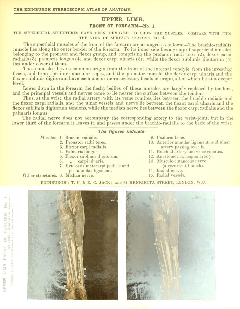 UPPER LIMB. FRONT OF FOREARM—No. 1. THE SUPERFICIAL STRUCTURES HAVE BEEN REMOVED THE VIEW OF SURFACE TO SHOW THE MUSCLES. ANATOMY NO. 4. COMPARE WITH THIS The superficial muscles of the front of the forearm are arranged as follows:—The brachio-radialis muscle lies along the outer border of the forearm. To its inner side lies a group of superficial muscles belonging to the pronator and flexor group, and comprising the pronator radii teres (2), flexor carpi radialis (3), palmaris longus (4), and flexor carpi ulnaris (6); while the flexor sublimis digitorum (5) lies under cover of them. These muscles have a common origin from the front of the internal condyle, from the investing fascia, and from the intermuscular septa, and the pronator muscle, the flexor carpi ulnaris and the flexor sublimis digitorum have each one or more accessory heads of origin, all of which lie at a deeper level. Lower down in the forearm the fleshy bellies of these muscles are largely replaced by tendons, and the principal vessels and nerves come to lie nearer the surface between the tendons. Thus, at the wrist, the radial artery, with its vense comites, lies between the brachio-radialis and the flexor carpi radialis, and the ulnar vessels and nerve lie between the flexor carpi ulnaris and the flexor sublimis digitorum tendons, while the median nerve lies between the flexor carpi radialis and the palmaris longus. The radial nerve does not accompany the corresponding artery to the wrist-joint, but in the lower third of the forearm it leaves it, and passes under the brachio-radialis to the back of the wrist. The figures indicate- Muscles. 1. Brachio-radialis. 2. Pronator radii teres. 3. Flexor carpi radialis. 4. Palmaris longus. 5. Flexor sublimis digitorum. 6. ,, carpi ulnaris. 7. Ext. ossis metacarpi pollicis and postannular ligament. Other structures. 8. Median nerve. EDINBURGH: T. C. & E. C. JACK; and 34 HENRIETTA STREET, LONDON, W.C. 9. Pisiform bone. 10. Anterior annular ligament, and ulnar artery passing over it. 11. Brachial artery and venae comites. 12. Anastomotica magna artery. 13. Musculo-cutaneous nerve (a recurrent branch). 14. Radial nerve. 15. Radial vi