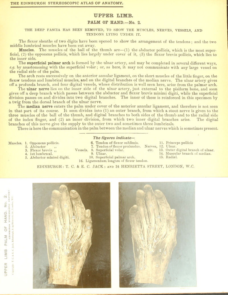 UPPER LIMB. PALM OP HAND.—No. 2. THE DEEP FASCIA HAS BEEN REMOVED, TO SHOW THE MUSCLES, NERVES, VESSELS, AND TENDONS LYING UNDER IT. The flexor sheaths of two digits have been opened to show the arrangement of the tendons; and the two middle lnmbrical muscles have been cut away. Muscles. The muscles of the ball of the thumb are—(1) the abductor pollicis, which is the most super- ficial, (2) the opponens pollicis, which lies largely under cover of it, ^3) the flexor brevis pollicis, which lies to the inner side. The superficial palmar arch is formed by the ulnar artery, and may be completed in several different ways, e.g. by anastomosing with the superficial volar; or, as here, it may not communicate with any large vessel on the radial side of the palm. The arch rests successively on the anterior annular ligament, on the short muscles of the little finger, on the flexor tendons and lumbrical muscles, and on the digital branches of the median nerve. The ulnar artery gives off a profunda branch, and four digital vessels, whose distribution is well seen here, arise from the palmar arch. The ulnar nerve lies on the inner side of the ulnar artery, just external to the pisiform bone, and soon gives off a deep branch which passes between the abductor and flexor brevis minimi digiti, while the superficial division passes on and divides into two digital branches. The inner of these is reinforced in this specimen by a twig from the dorsal branch of the ulnar nerve. The median nerve enters the palm under cover of the anterior annular ligament, and therefore is not seen in that part of its course. It soon divides into (1) an outer branch, from which a stout nerve is given to the three muscles of the ball of the thumb, and digital branches to both sides of the thumb and to the radial side of the index finger, and (2) an inner division, from which two inner digital branches arise. The digital branches of this nerve give the supply to the outer two and sometimes three lumbricals. There is here the communication in the palm between the median and ulnar nerves which is sometimes present. The figures indicate— 6. Tendon of flexor sublimis. 11. Princeps pollicis 7. Tendon of flexor profundus. Nerves, 12. Ulnar. Vessels. 8. Superficial volar. etc. 13. Outer digital branch of ulnar. 9. Ulnar. 14. Muscular branch of mediaD. 10. Superficial palmar arcli. 15. Radial. 16. Ligamentum longum of flexor tendon. Muscles. 1. Opponens pollicis. 2. Abductor ,, 3. Flexor brevis ,, 4. 1st lumbrical. 5. Abductor minimi digiti.