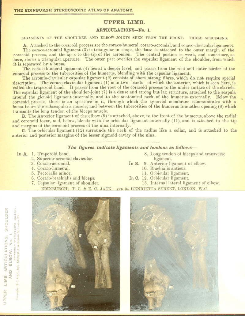 UPPER LIMB. ARTICULATIONS—No. 1. LIGAMENTS OF THE SHOULDER AND ELBOW-JOINTS SEEN FROM THE FRONT. THREE SPECIMENS. A. Attached to the coracoid process are the coraco-humeral, coraco-acromial, and coraco-clavicular ligaments. The coraco-acromial ligament (3) is triangular in shape, the base is attached to the outer margin of the coracoid process, and the apex to the tip of the acromion. The central portion is weak, and sometimes, as here, shows a triangular aperture. The outer part overlies the capsular ligament of the shoulder, from which it is separated by a bursa. The coraco-humeral ligament (4) lies at a deeper level, and passes from the root and outer border of the coracoid process to the tuberosities of the humerus, blending with the capsular ligament. The acromio-clavicular capsular ligament (2) consists of short strong fibres, which do not require special description. The coraco-clavicular ligament (1) is in two bands—of which the anterior, which is seen here, is called the trapezoid band. It passes from the root of the coracoid process to the under surface of the clavicle. The capsular ligament of the shoulder-joint (7) is a dense and strong but lax structure, attached to the scapula around the glenoid ligament internally, and to the anatomical neck of the humerus externally. Below the coracoid process, there is an aperture in it, through which the synovial membrane communicates with a bursa below the subscapularis muscle, and between the tuberosities of the humerus is another opening (8) which transmits the long tendon of the biceps muscle. B. The Anterior ligament of the elbow (9) is attached, above, to the front of the humerus, above the radial and coronoid fossae, and, below, blends with the orbicular ligament externally (11), and is attached to the tip and margins of the coronoid process of the ulna internally. C. The orbicular ligament (12) surrounds the neck of the radius like a collar, and is attached to the anterior and posterior margins of the lesser sigmoid cavity of the ulna. In A. The figures Indicate ligaments and tendons as follows— 1. Trapezoid band. 2. Superior acromio-clavicular. 3. Coraco-acromial. 4. Coraco-humeral. 5. Pectoralis minor. 6. Coraco-brachialis and biceps. 7. Capsular ligament of shoulder. In B. In C. 8. Long tendon of biceps and transverse ligament. 9. Anterior ligament of elbow. 10. Brachialis anticus. 11. Orbicular ligament. 12. Orbicular ligament. 13. Internal lateral ligament of elbow, EDINBURGH; T, C. & E. C. JACK: asp 34 HENRIETTA STREET, LONDON, W.C I o - CO S J ■ o . co 5 | z 61! 0 z s = D 2 s 1 Q ffi y | H LU 01 t i* i