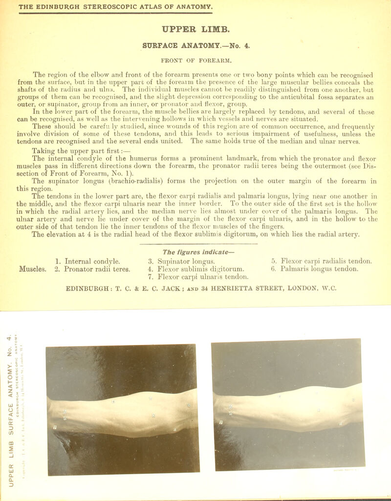 UPPER LIMB, SURFACE ANATOMY.—No. 4. FEONT OF FOREARM. The region of the elbow and front of the forearm presents one or two bony points which can be recognised from the surface, but in the upper part of the forearm the presence of the large muscular bellies conceals the shafts of the radius and ulna. The individual muscles cannot be readily distinguished from one another, but groups of them can be recognised, and the slight depression corresponding to the anticubital fossa separates an outer, or supinator, group from an inner, or pronator and flexor, group. In the lower part of the forearm, the muscle bellies are largely replaced by tendons, and several of these can be recognised, as well as the intervening hollows in which vessels and nerves are situated. These should be carefu ly studied, since wounds of this region are of common occurrence, and frequently involve division of some of these tendons, and this leads to serious impairment of usefulness, unless the tendons are recognised and the several ends united. The same holds true of the median and ulnar nerves. Taking the upper part first:— The internal condyle of the humerus forms a prominent landmark, from which the pronator and flexor muscles pass in different directions down the forearm, the pronator radii teres being the outermost (see Dis- section of Front of Forearm, No. 1). The supinator longus (brachio-radialis) forms the projection on the outer margin of the forearm in this region. The tendons in the lower part are, the flexor carpi radialis and palmaris longus, lying near one another in the middle, and the flexor carpi ulnaris near the inner border. To the outer side of the first set is the hollow in which the radial artery lies, and the median nerve lies almost under cover of the palmaris longus. The ulnar artery and nerve lie under cover of the margin of the flexor carpi ulnaris, and in the hollow to the outer side of that tendon lie the inner tendons of the flexor muscles of the fingers. The elevation at 4 is the radial head of the flexor sublimis digitorum, on which lies the radial artery. 1. Internal condyle. Muscles. 2. Pronator radii teres. The figures indicate— 3. Supinator longus. 4. Flexor sublimis digitorum. 7. Flexor carpi ulnaris tendon. 5. Flexor carpi radialis tendon. 6. Palmaris longus tendon.