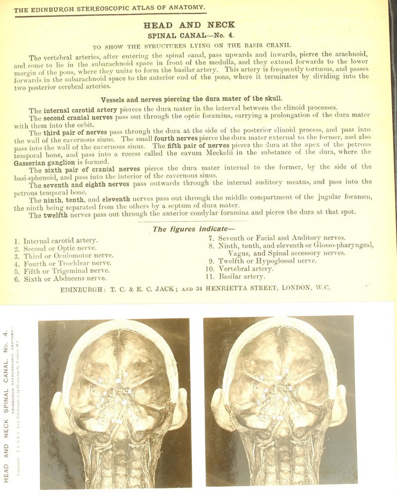 HEAD AND NECK SPINAL CANAL—No. 4. TO SHOW THE STRUCTURES LYING ON THE BASIS CRANII. The vertebral arteries, after entering the spinal canal, pass upwards and inwards, pierce the arachnoid, and come to lie in the subarachnoid space in front of the medulla, and they extend forwards to the lower mxro-in of the pons where they unite to form the basilar artery. This artery is frequently tortuous, and passes forwards in the subarachnoid space to the anterior end of the pons, where it terminates by dividing into the two posterior cerebral arteries. Vessels and nerves piercing the dura mater of the skull. The internal carotid artery pierces the dura mater in the interval between the clinoid processes. The second cranial nerves pass out through the optic foramina, carrying a prolongation of the dura mater with them into the orbit. ..... , The third pair of nerves pass through the dura at the side of the posterior clinoid process, and pass into the wall of the cavernous sinus. The small fourth nerves pierce the dura mater external to the former, and also pass into the wall of the cavernous sinus. The fifth pair of nerves pierce the dura at the apex of the petrous temporal bone, and pass into a recess called the cavum Meckelii in the substance of the dura, where the Gasserian ganglion is formed. , The sixth pair of cranial nerves pierce the clura mater internal to the former, by the side of the basi-sphenoid, and pass into the interior of the cavernous sinus. The seventh and eighth nerves pass outwards through the internal auditory meatus, and pass into the petrous temporal bone. . . . . The ninth, tenth, and eleventh nerves pass out through the middle compartment of the jugular foramen, the ninth being separated from the others by a septum of dura mater. The twelfth nerves pass out through the anterior condylar foramina and pierce the dura at that spot. The figures indicate— 1. Internal carotid artery. 7- Seventh or Facial and Auditory nerves. 2 Second or Optic nerve. 8- Ninth, tenth, and eleventh or Glossopharyngeal, 3 Third or Oculomotor nerve. Vagus, and Spinal accessory nerves. 4 Fourth or Trochlear nerve. 9. Twelfth or Hypoglossal nerve. 5 Fifth or Trigeminal nerve. 10. Vertebral artery. 6. Sixth or Abducens nerve. H. Basilar artery.