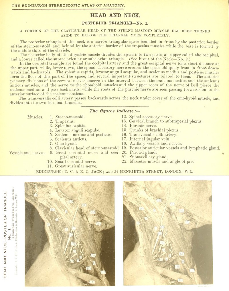 HEAD AND NECK. POSTERIOR TRIANGLE —No. 1. A PORTION OF THE CLAVICULAR HEAD OF THE STERNO-MASTOID MUSCLE HAS BEEN TURNED ASIDE TO EXPOSE THE TRIANGLE MORE COMPLETELY. The posterior triangle of the neck is a narrow triangular space bounded in front by the posterior boixler of the sterno-raastoid, and behind by the anterior border of the trapezius muscles while the base is formed by the middle third of the clavicle. The posterior belly of the digastric muscle divides the space into two parts, an upper called the occipital, and a lower called the supraclavicular or subclavian triangle. (See Front of the Neck—No. 2.) In the occipital triangle are found the occipital artery and the great occipital nerve for a short distance at the upper part, while, loAver down, the spinal accessory nerve crosses the space obliquely from in front down- wards and backwards. The splenius capitis, levator anguli scapulae, and scalenus medius and posticus muscles form the floor of this part of the space, and several important structures are related to them. The anterior primary divisions of the cervical nerves emerge in the interval between the scalenus medius and the scalenus anticus muscles, and the nerve to the rhomboid muscles and the upper roots of the nerve of Bell pierce the scalenus medius, and pass backwards, while the roots of the phrenic nerve are seen passing forwards on to the anterior surface of the scalenus anticus. The transversalis colli artery passes backwards across the neck under cover of the omo-hyoid muscle, and divides into its two terminal branches. The figures indicate:— Vessels and nerves. Muscles. 1. Sterno-mastoid. 12. Spinal accessory nerve. 2. Trapezius. 13. Cervical branch to subtrapezial plexus. 3. Splenius capitis. 14. Phrenic nerve. 4. Levator anguli scapula?. 15. Trunks of brachial plexus. 5. Scalenus medius and posticus. 16. Transversalis colli artery. 6. Scalenus anticus. 17. Internal jugular vein. 7. Omo-hyoid. 18. Axillary vessels and nerves. 8. Clavicular head of sterno-mastoid. 19. Posterior auricular vessels and lymphatic gland. 9. Great occipital nerve and occi- 20. Parotid gland.