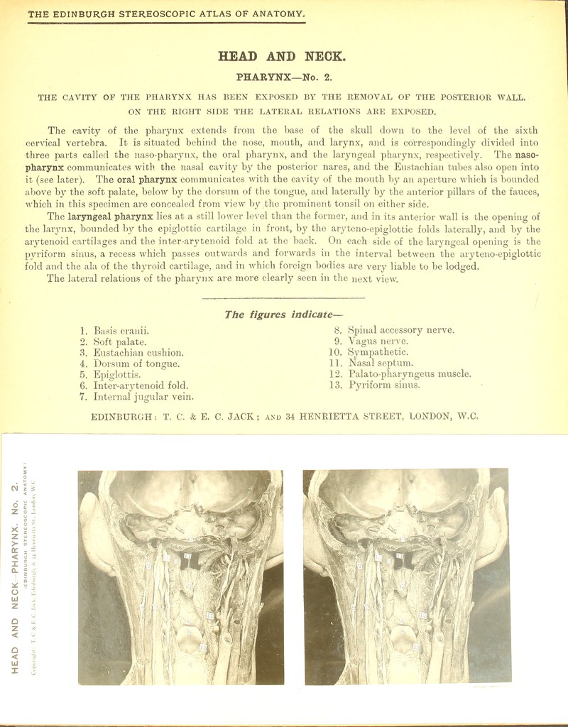 HEAD AND NECK. PHARYNX—No. 2. THE CAVITY OF THE PHARYNX HAS BEEN EXPOSED BY THE REMOVAL OF THE POSTERIOR WALL. ON THE RIGHT SIDE THE LATERAL RELATIONS ARE EXPOSED. The cavity of the pharynx extends from the base of the skull down to the level of the sixth cervical vertebra. It is situated behind the nose, mouth, and larynx, and is correspondingly divided into three parts called the naso-pharynx, the oral pharynx, and the laryngeal pharynx, respectively. The naso- pharynx communicates with the nasal cavity by the posterior nares, and the Eustachian tubes also open into it (see later). The oral pharynx communicates with the cavity of the mouth by an aperture which is bounded above by the soft palate, below by the dorsum of the tongue, and laterally by the anterior pillars of the fauces, which in this specimen are concealed from view by the prominent tonsil on either side. The laryngeal pharynx lies at a still lower level than the former, and in its anterior wall is the opening of the larynx, bounded by the epiglottic cartilage in front, by the aryteno-epiglottic folds laterally, and by the arytenoid cartilages and the inter-arytenoid fold at the back. On each side of the laryngeal opening is the pyriform sinus, a recess which passes outwards and forwards in the interval between the aryteno-epiglottic fold and the ala of the thyroid cartilage, and in which foreign bodies are very liable to be lodged. The lateral relations of the pharynx are more clearly seen in the next view. The figun 1. Basis cranii. 2. Soft palate. 3. Eustachian cushion. 4. Dorsum of tongue. 5. Epiglottis. 6. Inter-arytenoid fold. 7. Internal jugular vein. indicate— 8. Spinal accessory nerve. 9. Vagus nerve. 10. Sympathetic. 11. Nasal septum. 12. Palato-pharyngeus muscle. 13. Pyriform sinus.