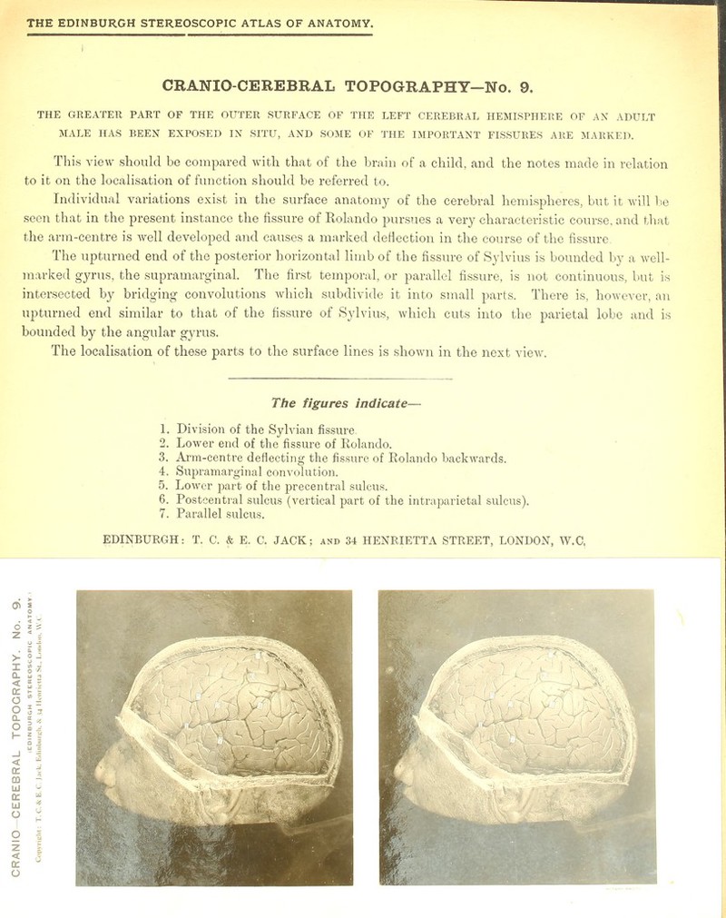 CRANIO CEREBRAL TOPOGRAPHY—No. 9. THE GREATER PART OF THE OUTER SURFACE OF THE LEFT CEREBRAL HEMISPHERE OF AN ADULT MALE HAS BEEN EXPOSED IN SITU, AND SOME OF THE IMPORTANT FISSURES ARE MARKED. This view should be compared with that of the brain of a child, and the notes made in relation to it on the localisation of function should be referred to. Individual variations exist in the surface anatomy of the cerebral hemispheres, but it will be seen that in the present instance the fissure of Rolando pursues a very characteristic course, and that the arm-centre is well developed and causes a marked deflection in the course of the fissure The upturned end of the posterior horizontal limb of the fissure of Sylvius is bounded by a Avell- marked gyrus, the supramarginal. The first temporal, or parallel fissure, is not continuous, but is intersected by bridging convolutions which subdivide it into small parts. There is, however, an upturned end similar to that of the fissure of Sylvius, which cuts into the parietal lobe and is bounded by the angular gyrus. The localisation of these parts to the surface lines is shown in the next view. The figures indicate— 1. Division of the Sylvian fissure. 2. Lower end of the fissure of Eolando. 3. Arm-centre deflecting the fissure of Eolando backwards. 4. Supramarginal convolution. 5. Lower part of the precentral sulcus. 6. Postcentral sulcus (vertical part of the intraparietal sulcus). 7. Parallel sulcus.