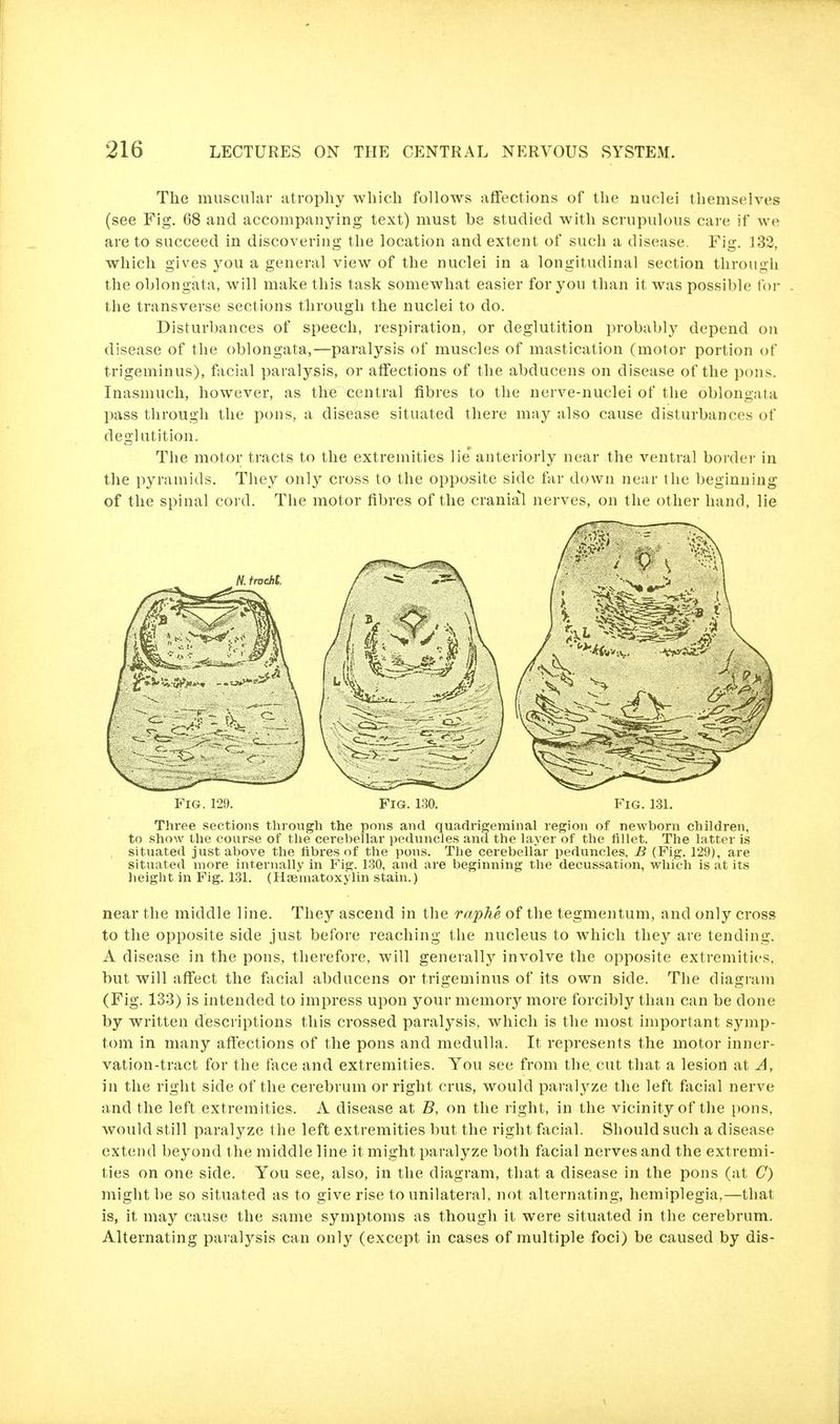 The muscular atrophy which follows affections of the nuclei themselves (see Fig, 68 and accompanying text) must be studied with scrupulous care if we are to succeed in discovering the location and extent of such a disease. Fig. 132, which gives you a general view of the nuclei in a longitudinal section through the oblongata, will make this task somewhat easier for you than it was possible for the transverse sections through the nuclei to do. Disturbances of speech, respiration, or deglutition probably depend on disease of the oblongata,—paralysis of muscles of mastication (motor portion of trigeminus), facial paralysis, or affections of the abducens on disease of the pons. Inasmuch, however, as the central fibres to the nerve-nuclei of the oblongata pass through the pons, a disease situated there may also cause disturbances of deglutition. The motor tracts to the extremities lie' anteriorly near the ventral boi'der in the pyramids. They only cross to the opposite side far down near the beginning of the spinal cord. The motor fibres of the cranial nerves, on the other hand, lie Fig. 112!). Fig. 180. Fig. 131. Three sections through the pons and quadrigeminal region of newborn children, to show the course of the cerebellar peduncles and the layer of the fillet. The latter is situated just above the fibres of the pons. The cerebellar peduncles, B (Fig. 129), are situated more internally in Fig. 130, and are beginning the decussation, which is at its lieight in Fig. 131. (Hseniatoxylin stain.) near the middle line. They ascend in the raphe of the tegmentum, and only cross to the opposite side just before reaching the nucleus to which they are tending. A disease in the pons, therefore, will generally involve the opposite extremities, but will affect the facial abducens or trigeminus of its own side. The diagi-am (Fig. 133) is intended to impress upon your memory more forcibly than can be done by written descriptions this crossed paralysis, which is the most important symp- tom in many affections of the pons and medulla. It represents the motor inner- vation-tract for the face and extremities. You see from the. cut that a lesiort at A, in the right side of the cerebrum or right crus, would paralyze the left facial nerve and the left extremities. A disease at B, on the right, in the vicinity of the pons, would still paralyze the left extremities but the right facial. Should such a disease extend beyond the middle line it might paralyze both facial nerves and the extremi- ties on one side. You see, also, in the diagram, that a disease in the pons (at C) might be so situated as to give rise to unilateral, not alternating, hemiplegia,—that is, it may cause the same symptoms as though it were situated in the cerebrum. Alternating paralysis can only (except in cases of multiple foci) be caused by dis-