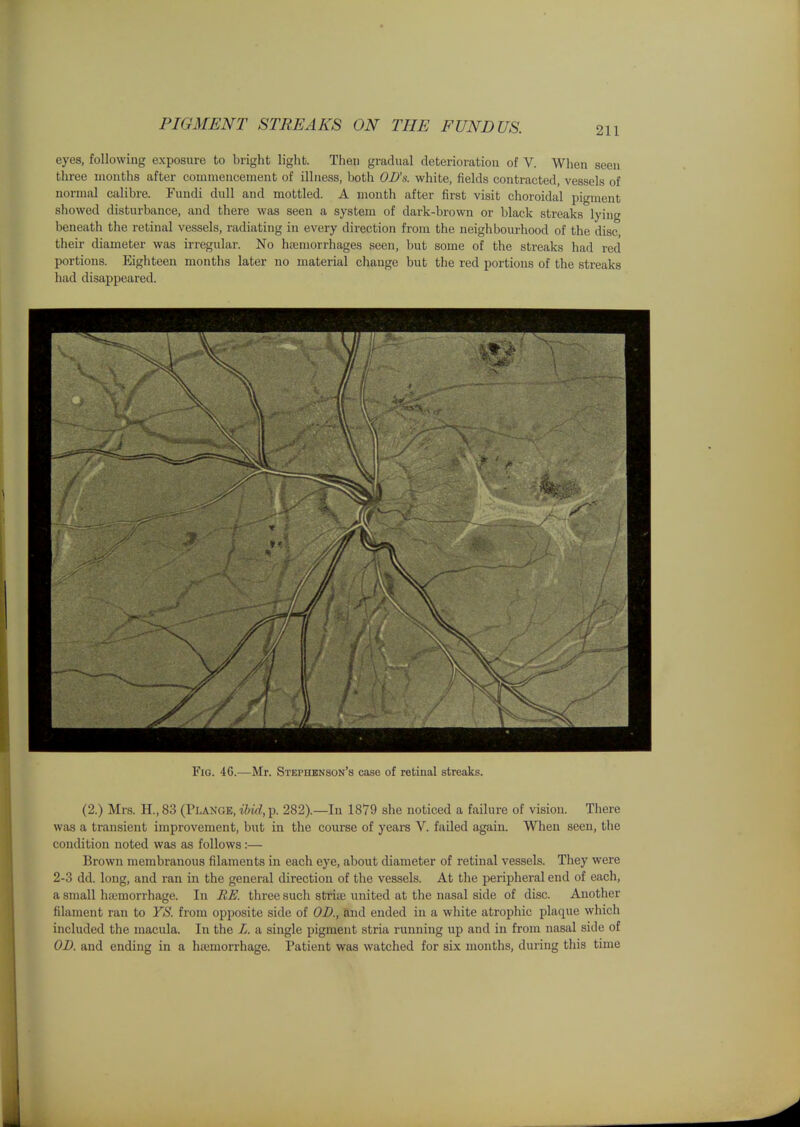 PIGMENT STREAKS ON THE FUNDUS. eyes, following exposure to bright light. Then gradual deterioration of V. When seen three months after commencement of illness, both OD's. white, fields contracted, vessels of normal calibre. Fundi dull and mottled. A month after first visit choroidal pigment showed disturbance, and there was seen a system of dark-brown or black streaks lying beneath the retinal vessels, radiating in every direction from the neighbourhood of the disc their diameter was irregular. No haimorrhages seen, but some of the streaks had red portions. Eighteen months later no material change but the red portions of the streaks had disappeared. Fig. 46.—Mr. Stephenson's case of retinal streaks. (2.) Mrs. H.,83 (Plange, iiirf, p. 282).—In 1879 she noticed a failure of vision. There was a transient improvement, but in the coui-se of years V. failed again. When seen, the condition noted was as follows:— Brown membranous filaments in each eye, about diameter of retinal vessels. They were 2-3 dd. long, and ran in the general direction of the vessels. At the peripheral end of each, a small haemorrhage. In RE. three such striae united at the nasal side of disc. Another filament ran to YS. from opposite side of OD., tad ended in a white atrophic plaque which included the macula. In the L. a single pigment stria running up and in from nasal side of OD. and ending in a hajmorrhage. Patient was watched for six months, during this time